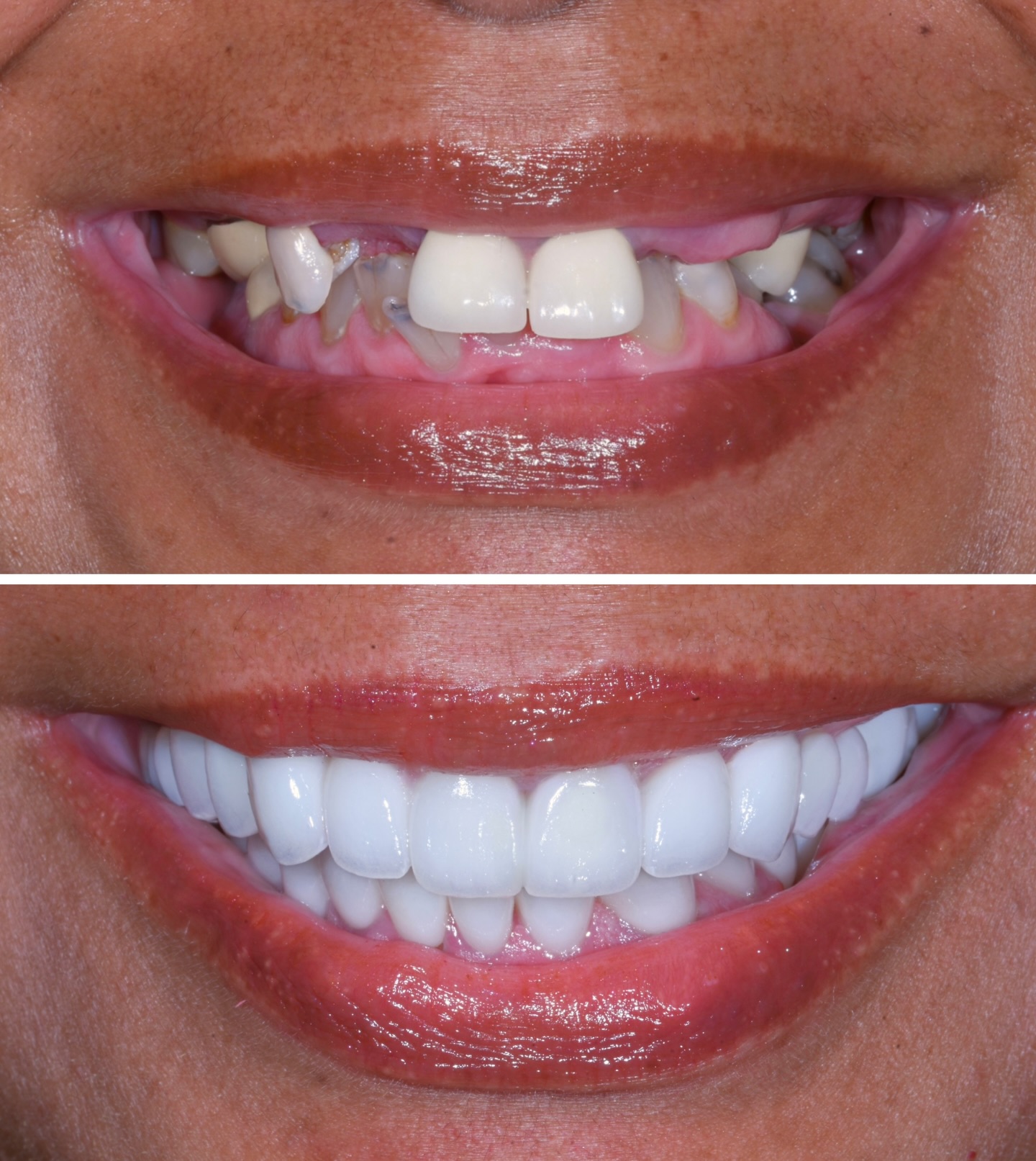 L.A. Smile Specialists Facebook ad: A full mouth reconstruction using our European imported…