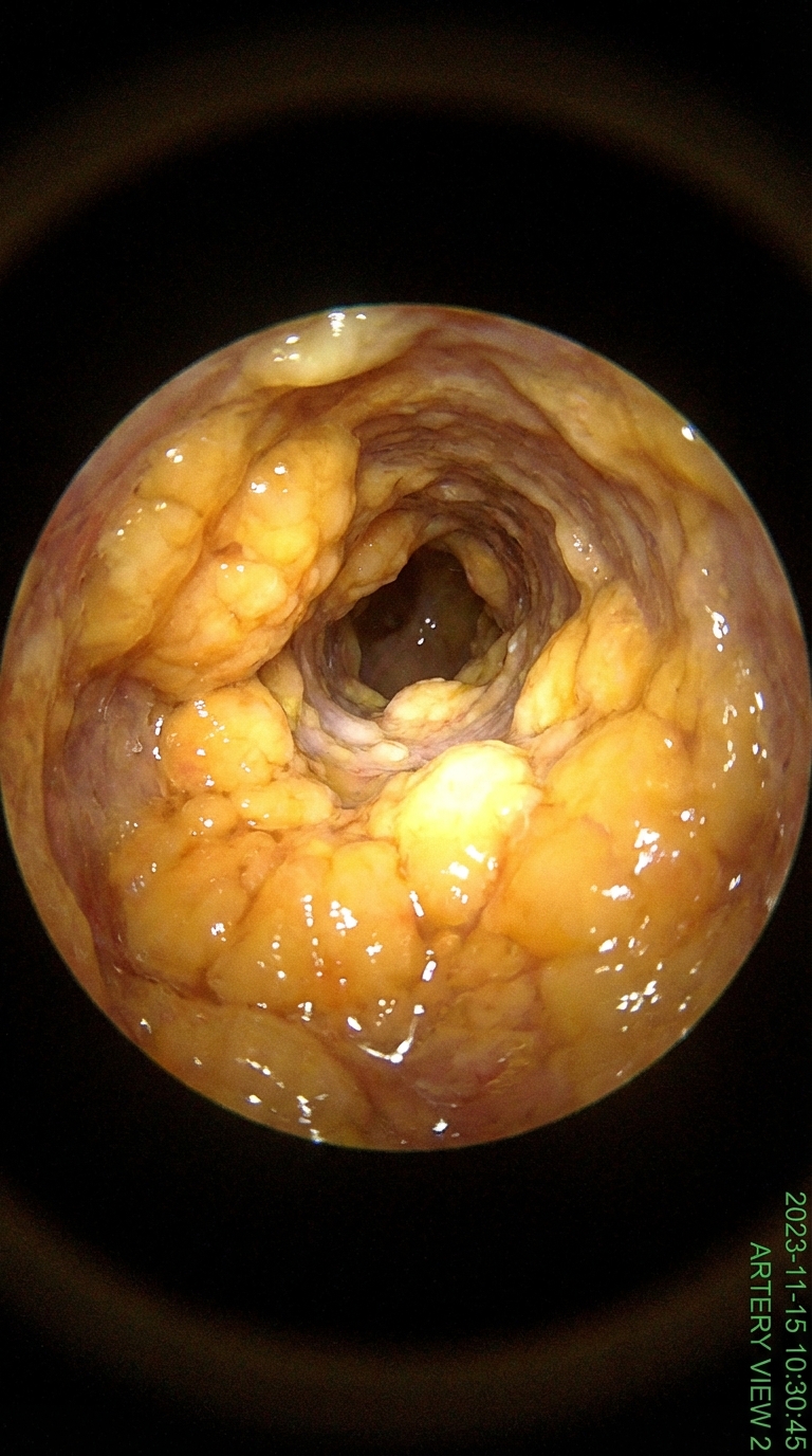 The Cholesterol Circle. Facebook ad