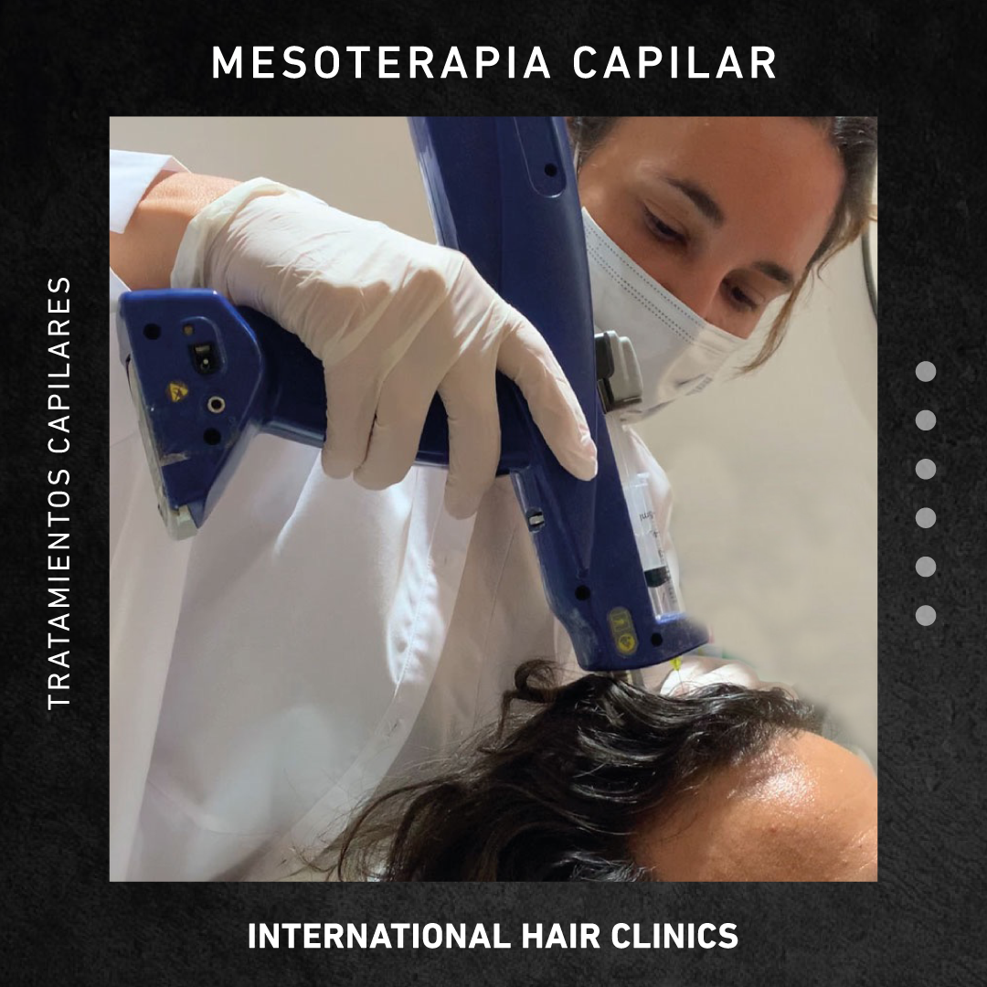 IHC Cordoba Facebook ad: Mesoterapia Capilar