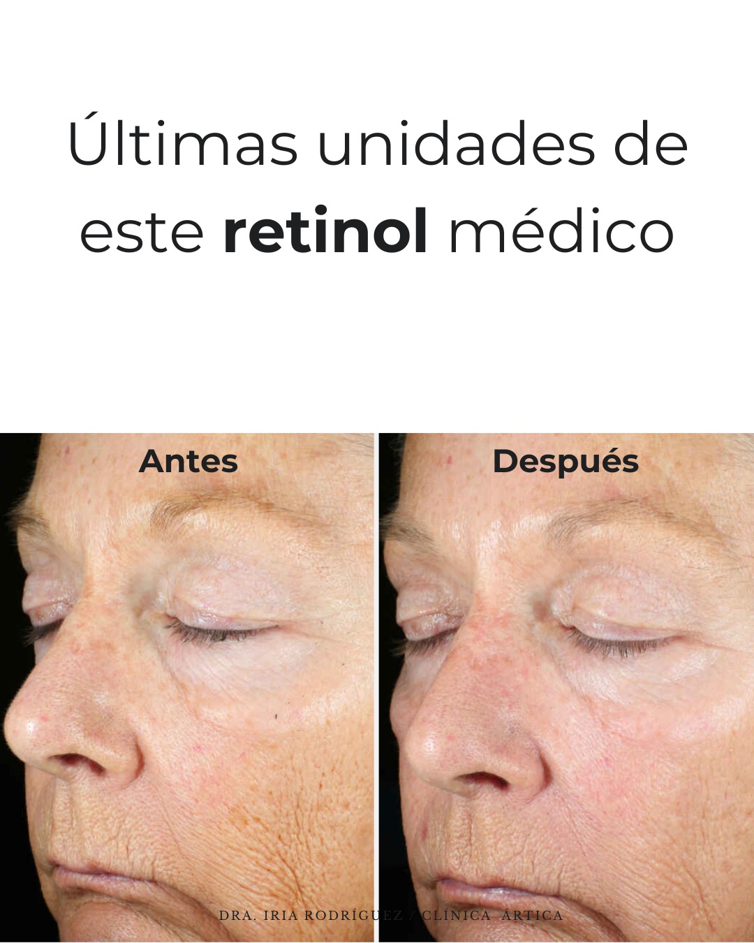 Ártica Medicina Estética Facebook ad: Últimas unidades disponibles de este retinol médico.