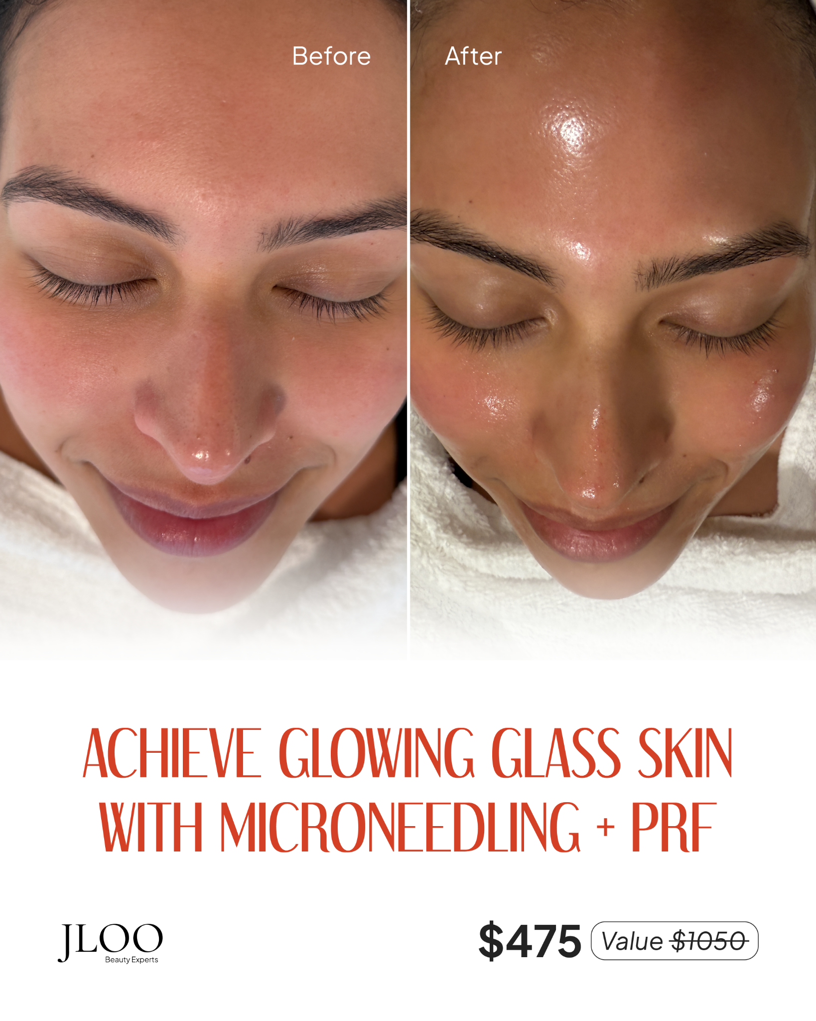 JLoo Beauty Experts Facebook ad: Achieve Glass Skin Glow With Microneedling + PRF