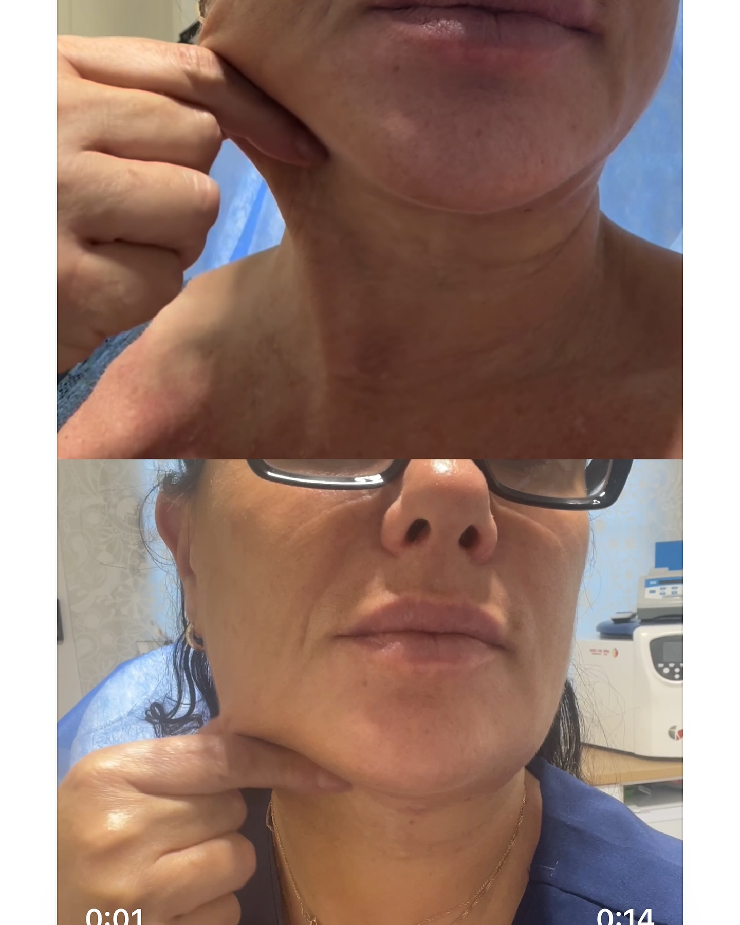 Dr. Kalliopi Gerakiou MD GP PhD MSc GHS Facebook ad: ENDOLIFT treatment