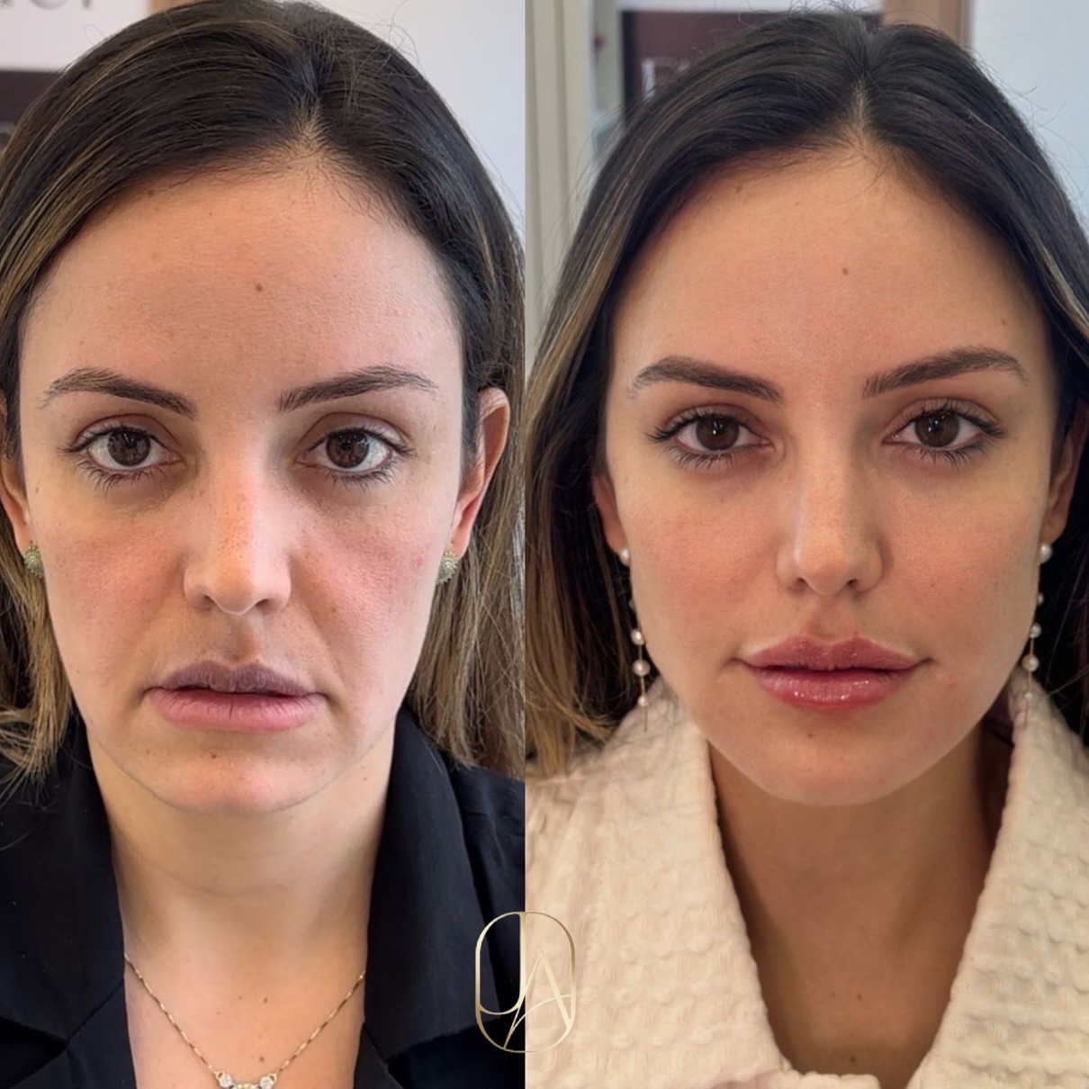 J.A Facebook ad: Esse foi o resultado da minha HARMONIZAÇÃO FACIAL!