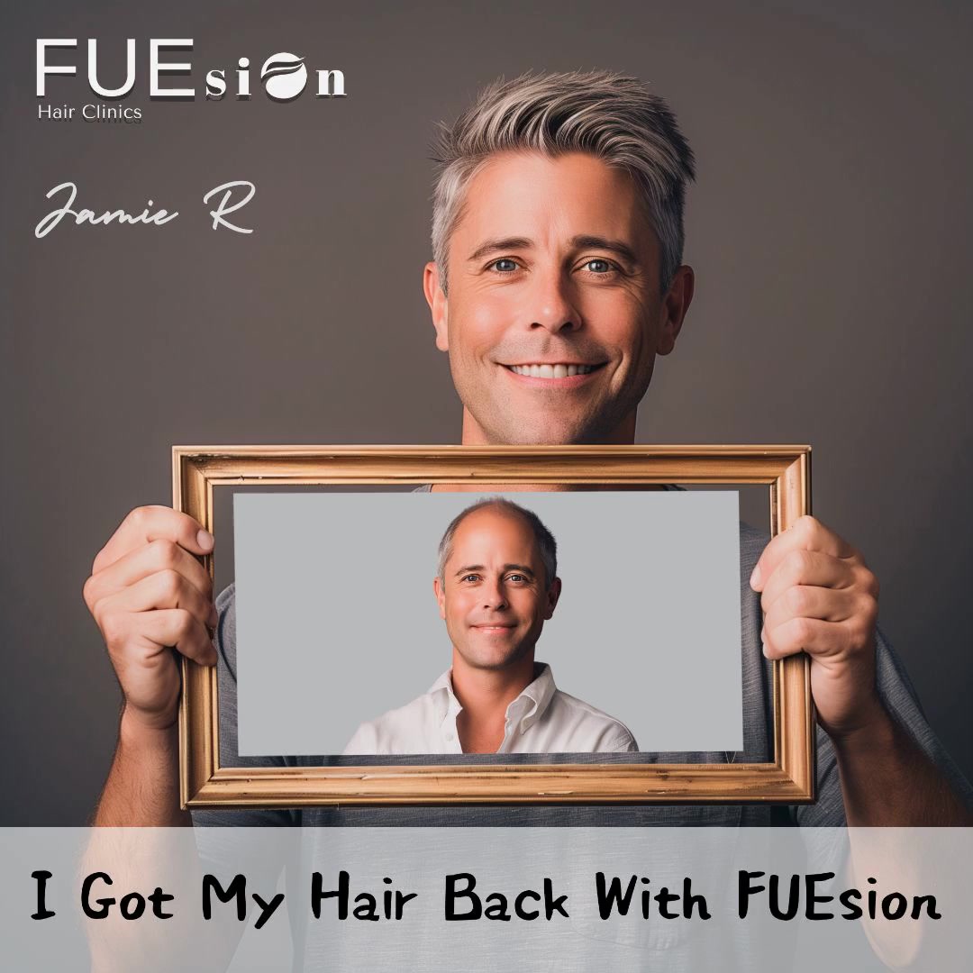 FUEsion Hair Clinics Facebook ad: Unlimited Hairs Robotic Hair Transplant @6.5K, Single Day…