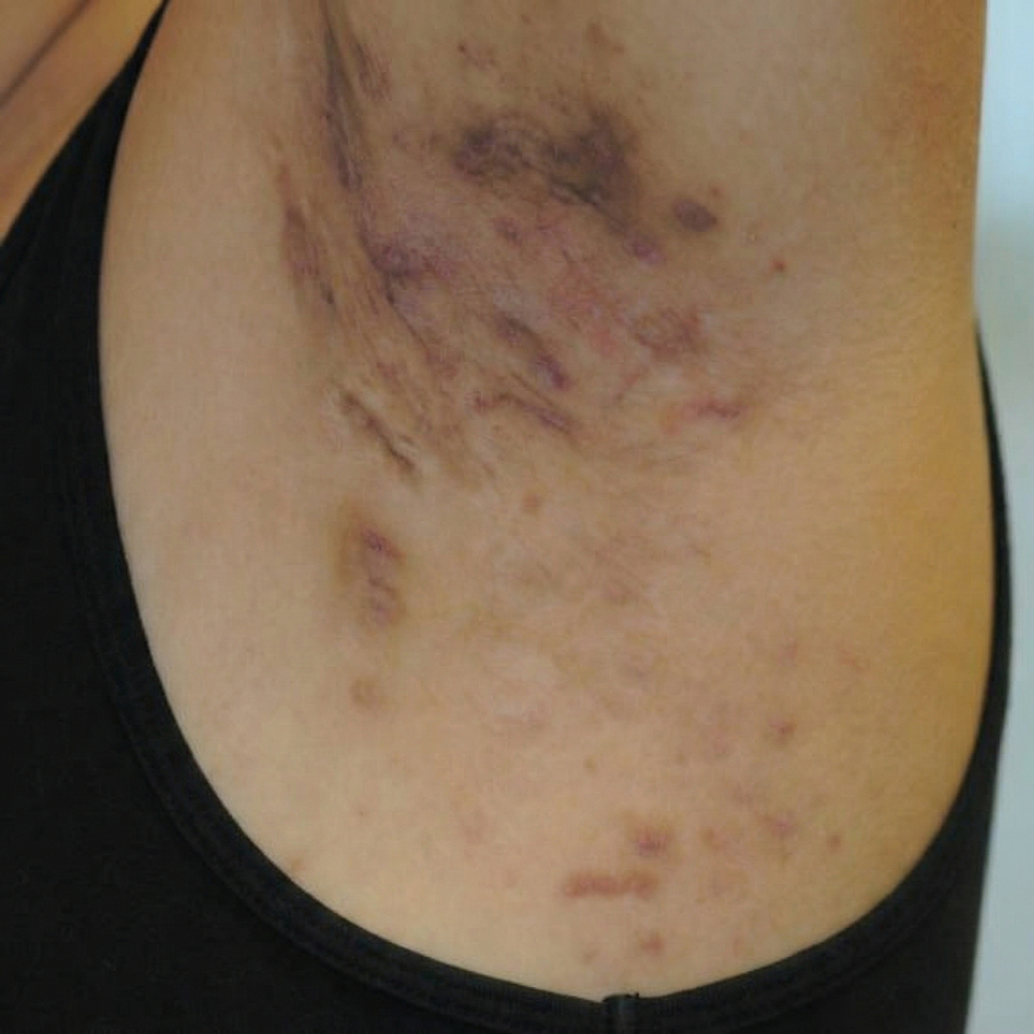 Sarah Brown Facebook ad: Read If You Suffer From Hidradenitis Suppurativa (HS)
