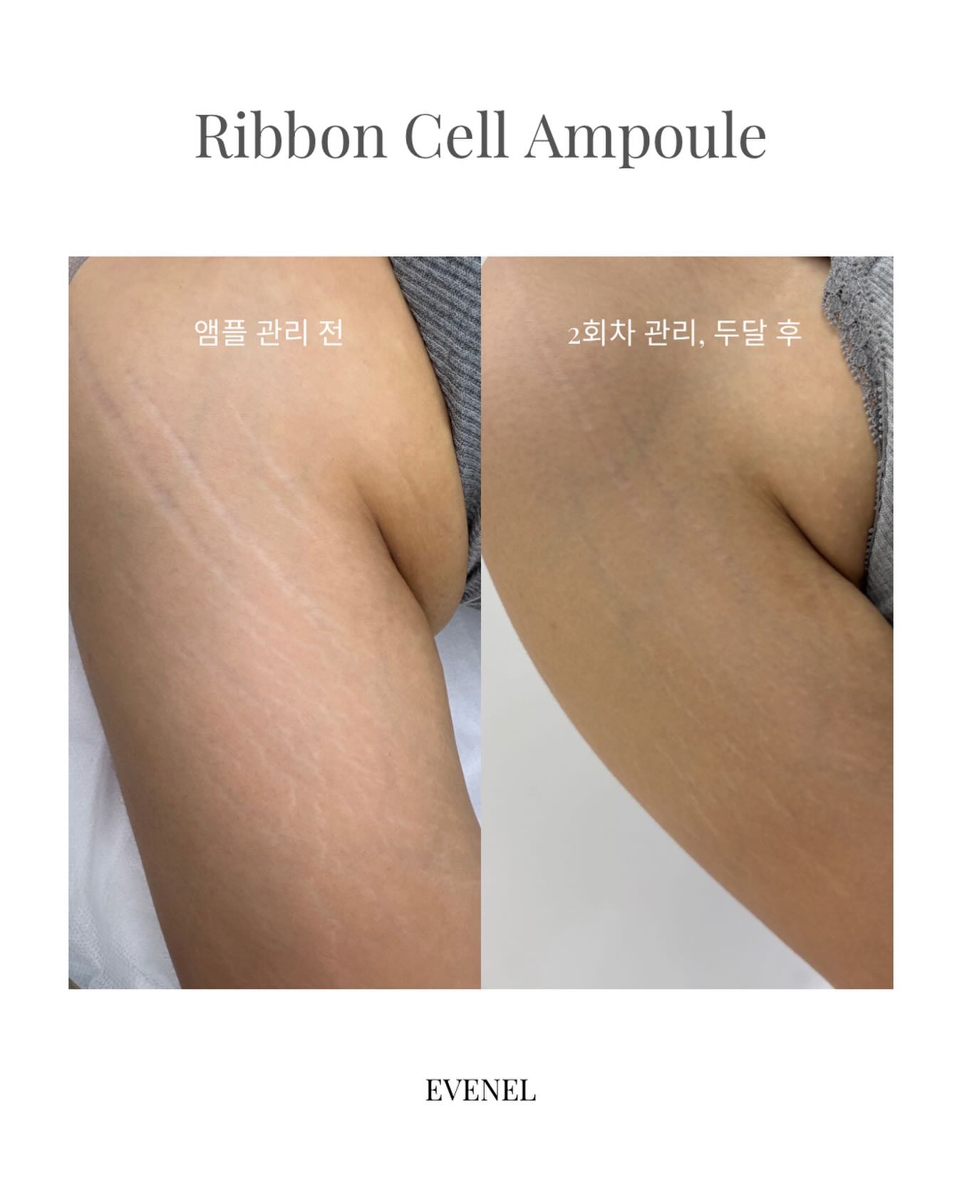 Scar/Stretch marks cover/Skin regeneration Facebook ad: 여름을 앞두고 시작했던