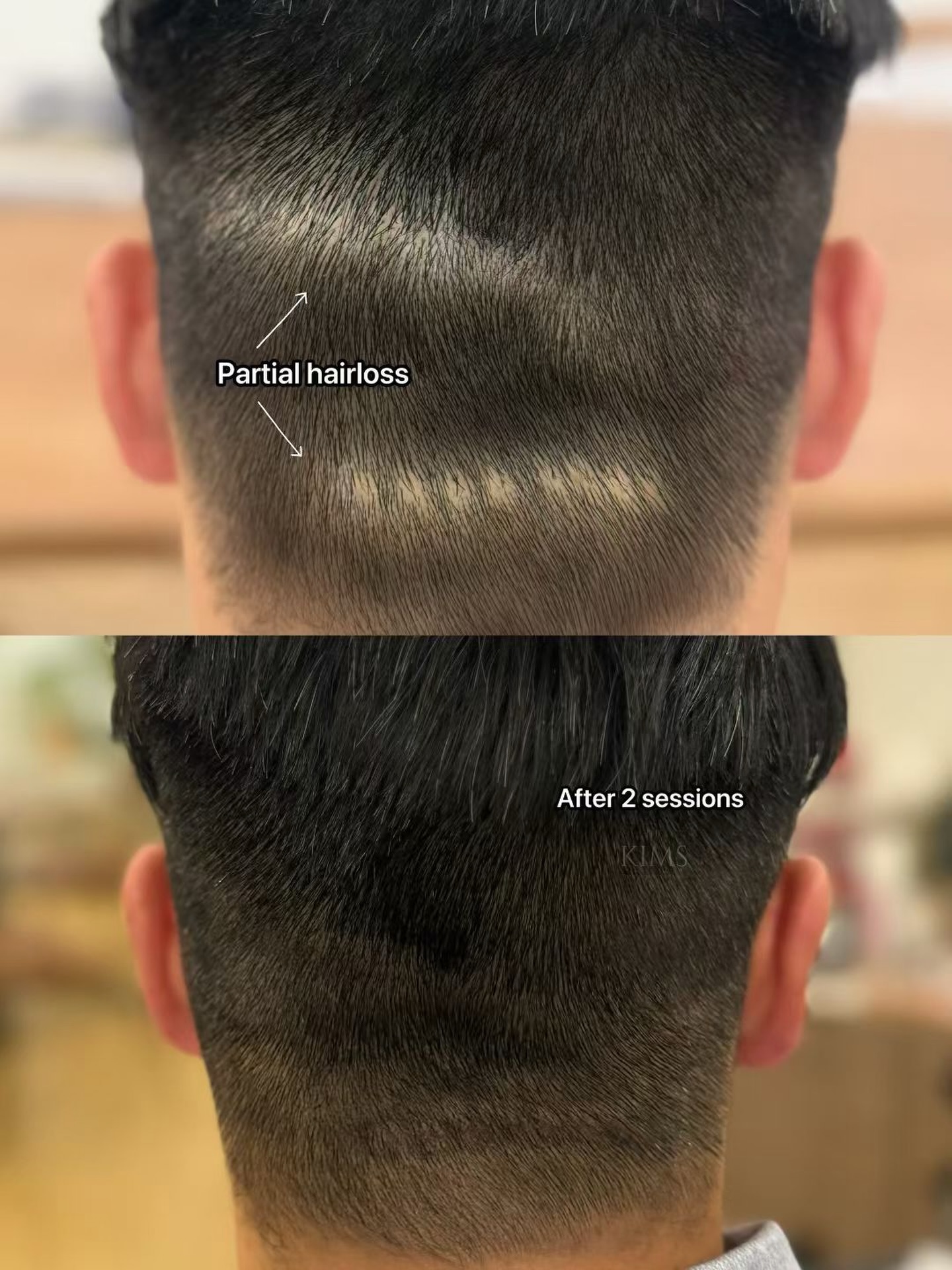 thekims_eric Facebook ad: Scalp Micropigmentation | Shanghai