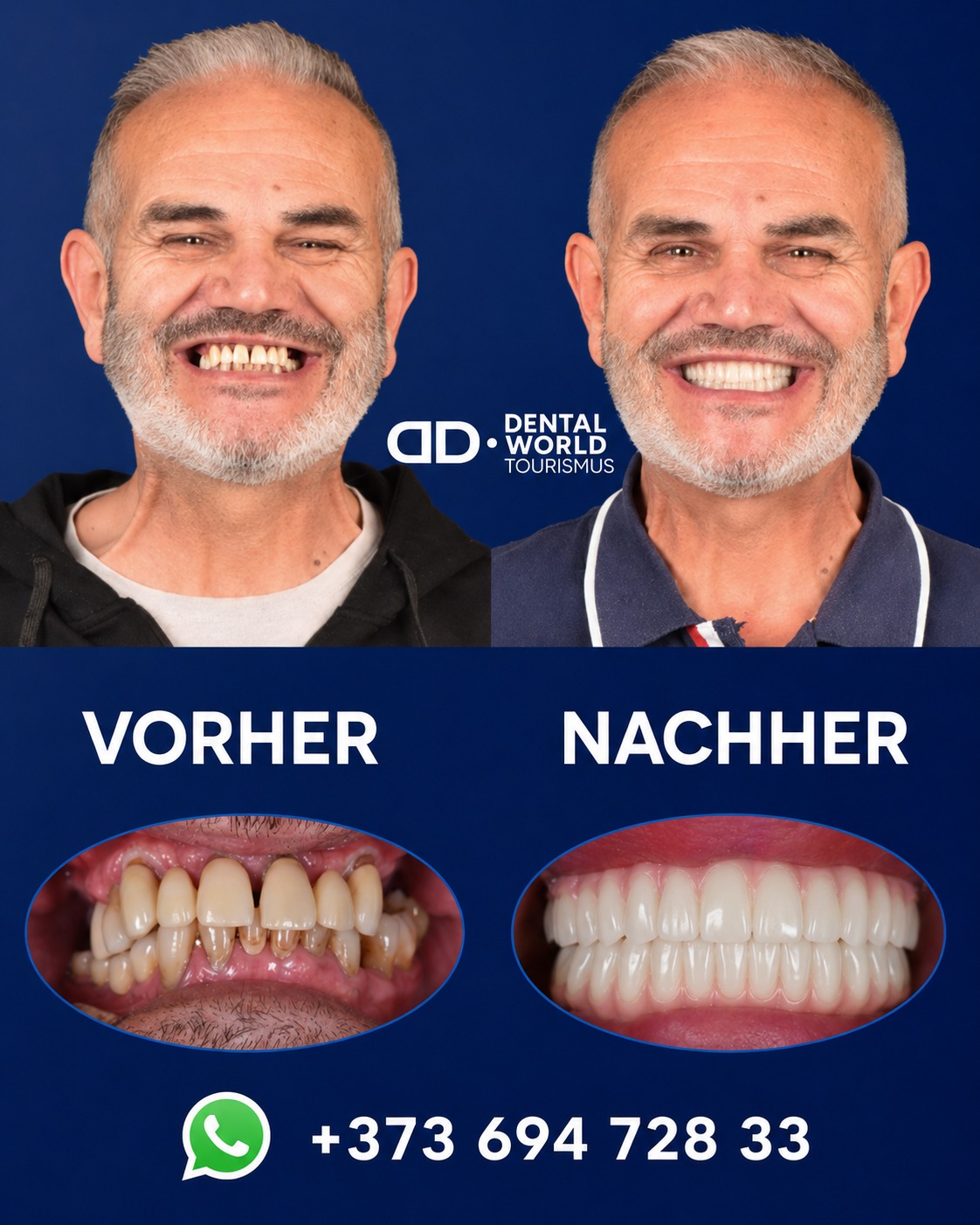 DDental World Tourism Deutschland Facebook ad: Vorher & Nachher, Die Veränderung mit ALL ON…