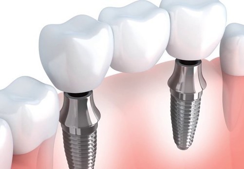 Fit to Smile Dental - Highlands Ranch Facebook ad: Take this QUIZ to see how EASY and AFFORDABLE dental…