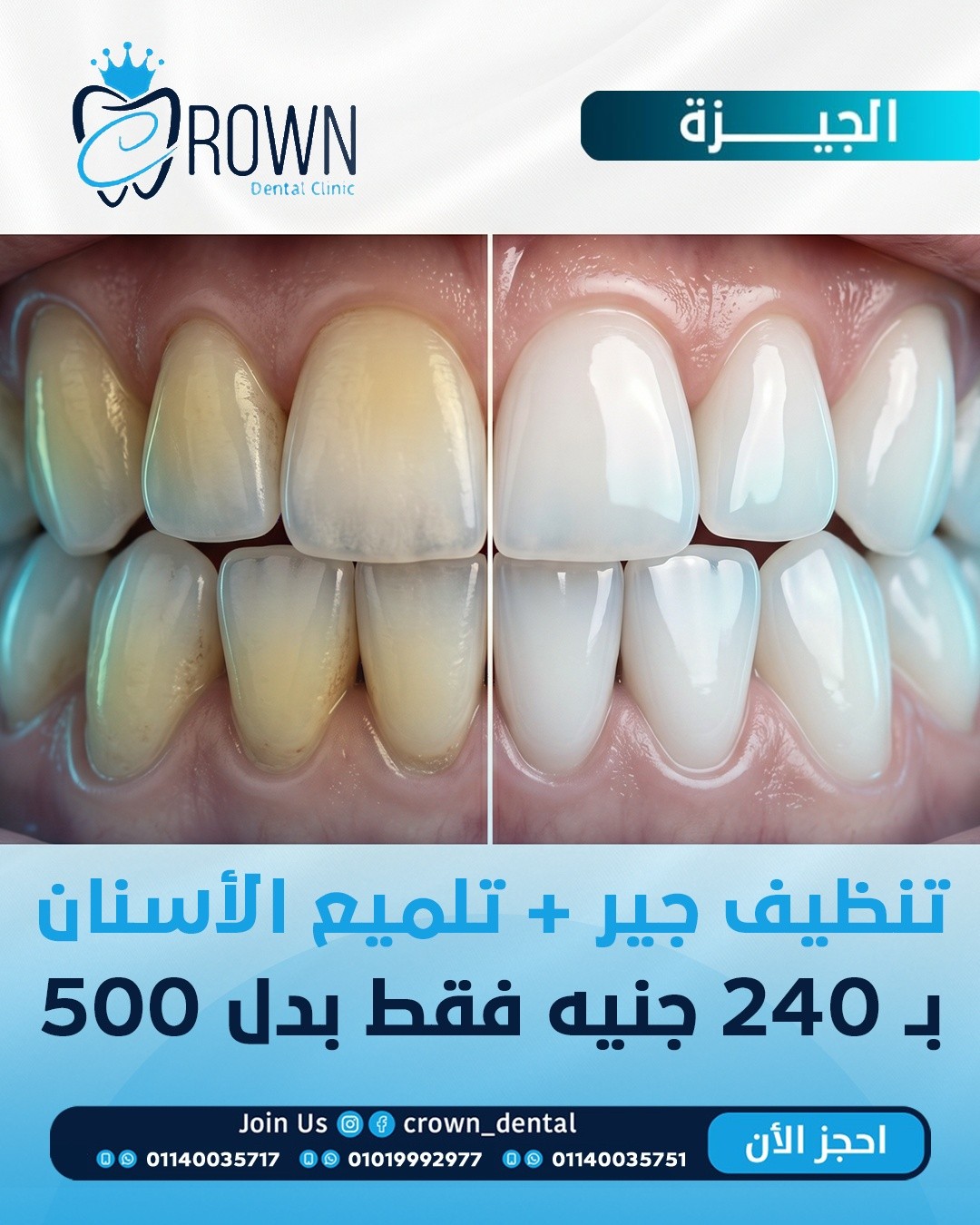 Crown Dental Clinic - فرع الجيزة Facebook ad: أسنانك باين عليها اصفرار أو طبقة جير مزعجة؟