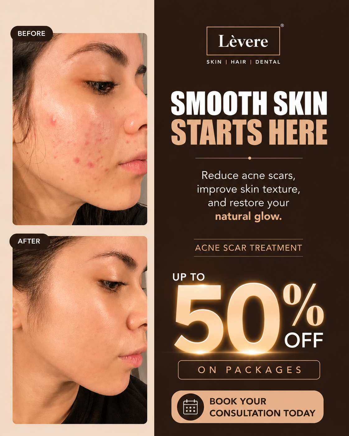 Levere Aesthetic Clinics Facebook ad: Treat Acne Scars, Don’t Hide Them