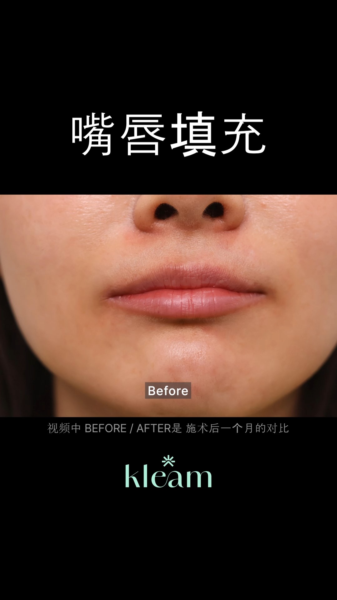 Kleam clinic Asia Facebook ad: Restylane Kiss 唇部填充物 before & after.