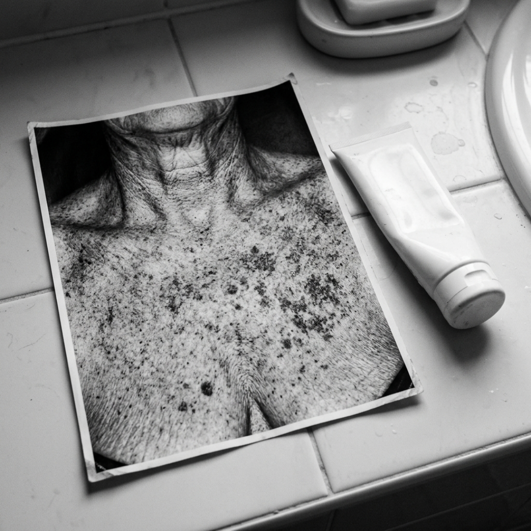 Xerosis Reset Facebook ad: Real Reason For Age Spots