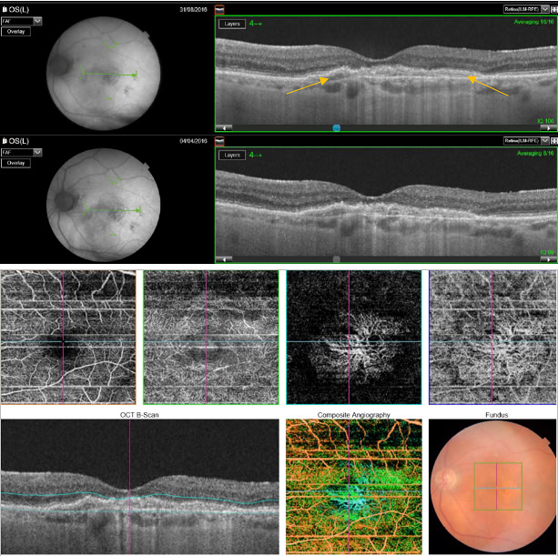 Liam Berg Facebook ad: Click here and stop Diabetic Retinopathy tomorrow
