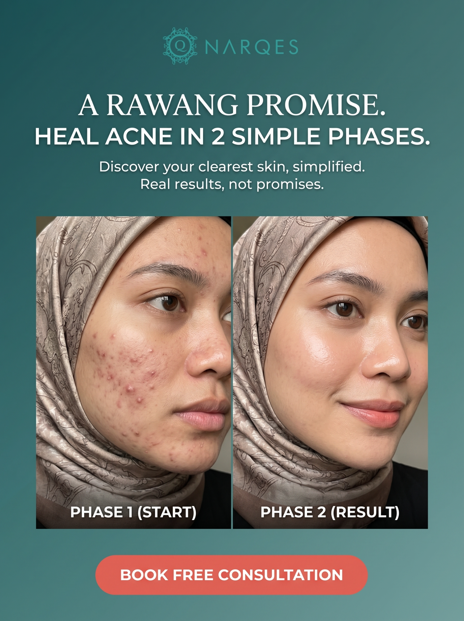 Narqes Aesthetics Rawang Facebook ad: Heal Stubborn Acne in Just 2 Simple Phases!