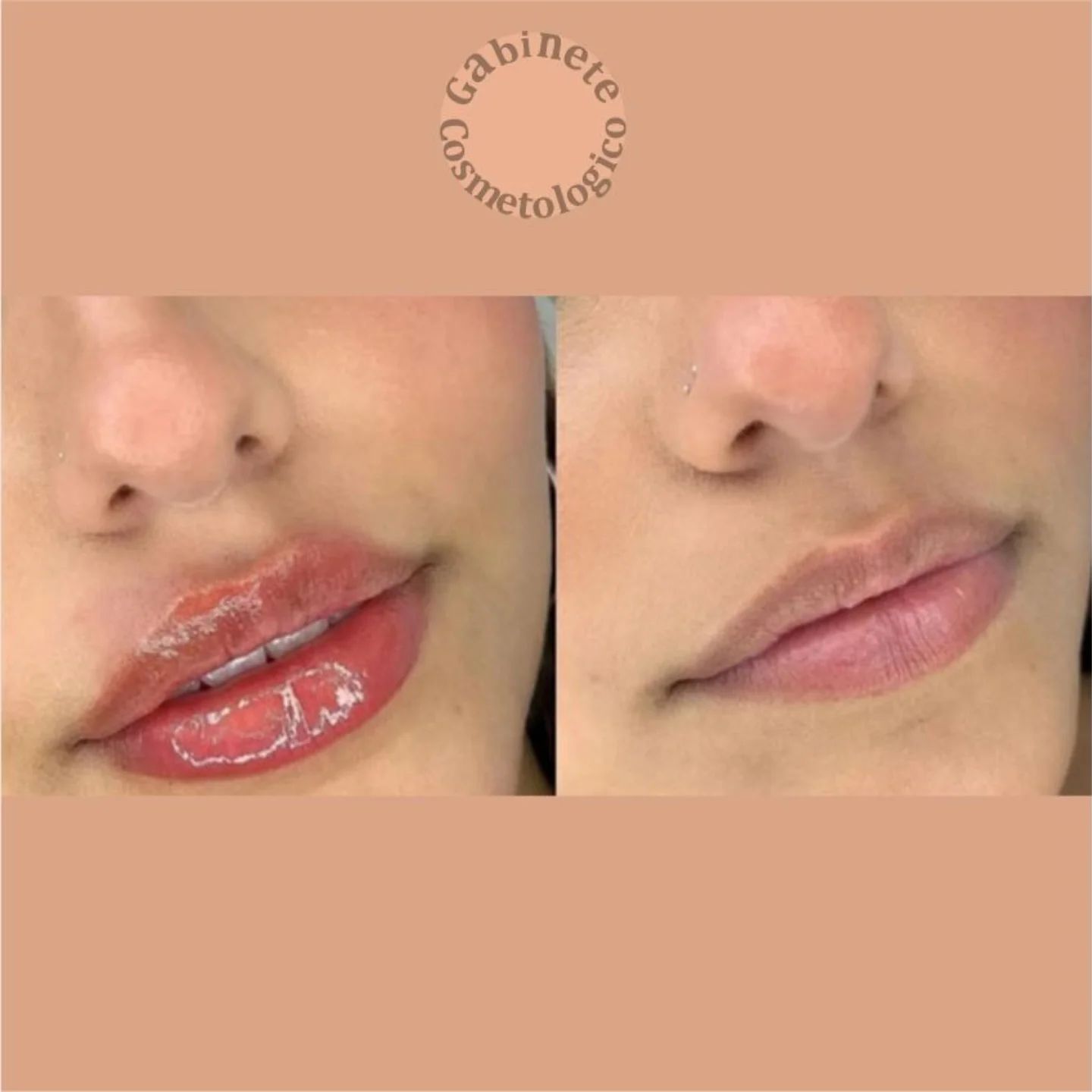 gabinetecosmetologico_com Facebook ad: ¡Resultados increíbles con nuestro BB Lips!