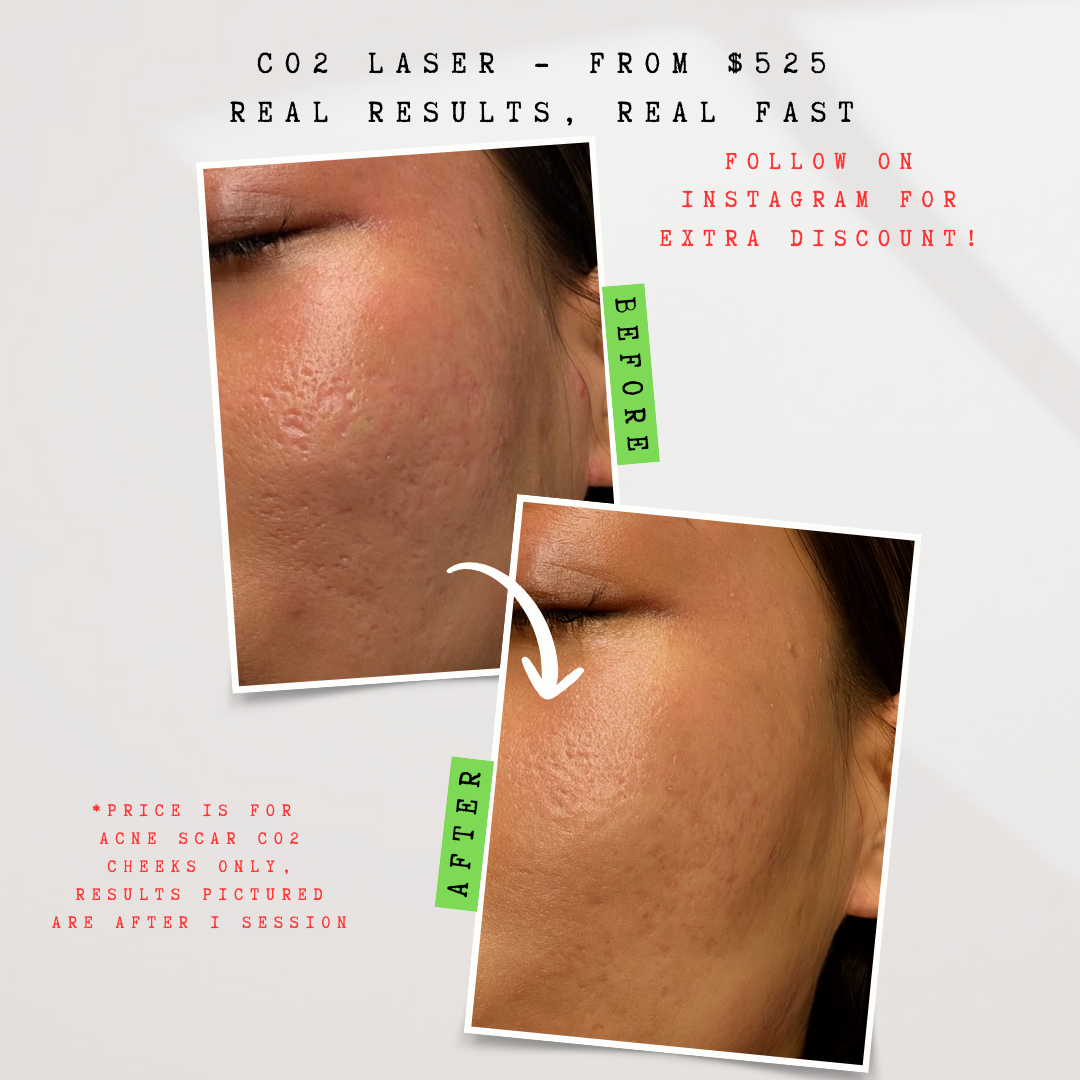 Laser by Tom Facebook ad: Fade Acne Scars with CO2 Laser!