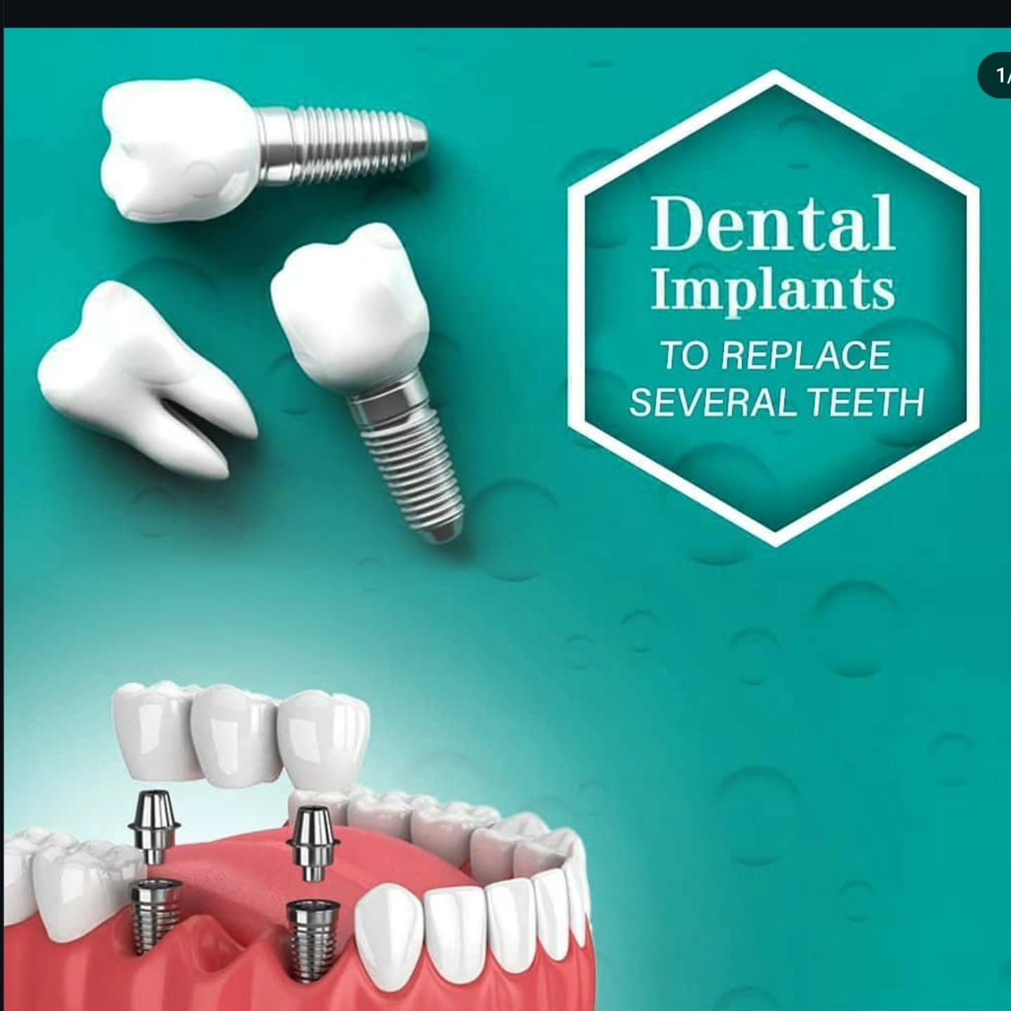 interchangedental Facebook ad: Dental implants: A modern solution for missing teeth.