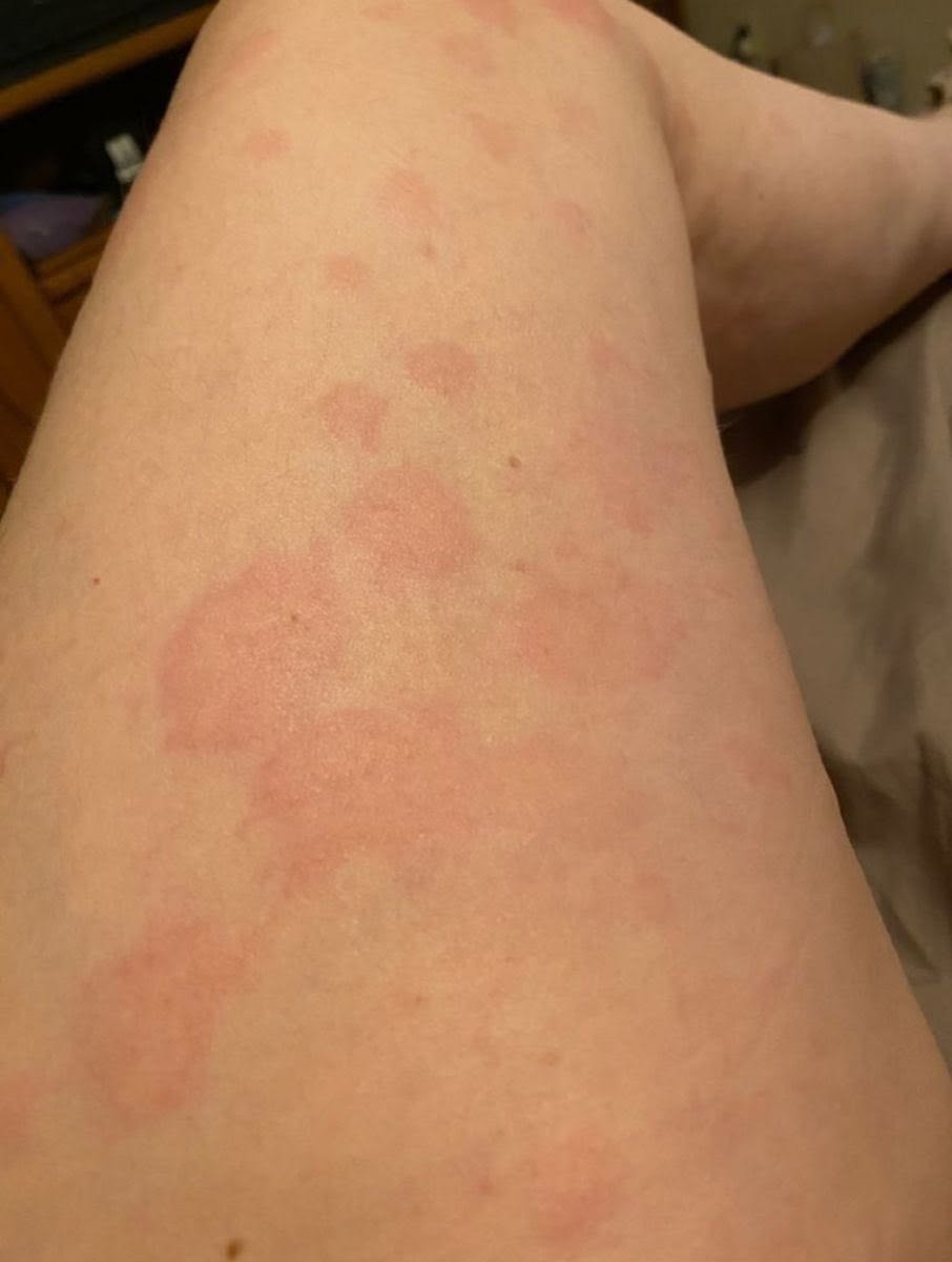 Barbara Turner Facebook ad: Type 2 Diabetics: This Itch Is A Warning.