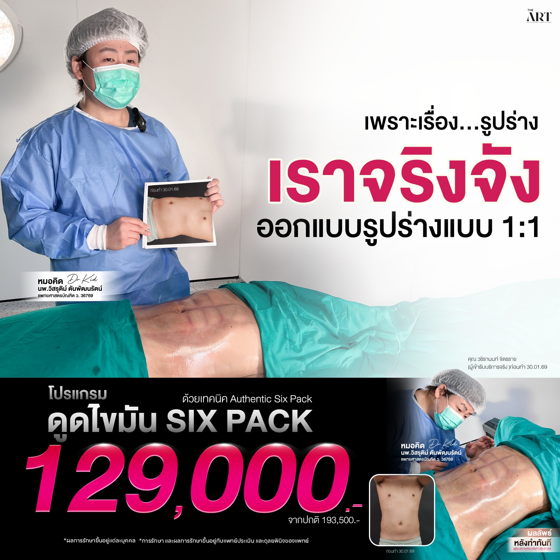 The Art Plastic Surgery Hospital โรงพยาบาลเฉพาะทางศัลยกรรมตกแต่งดิอาท Facebook ad: Six Pack มีอยู่แล้วทุกคน…แค่ถูกไขมันบังไว้?