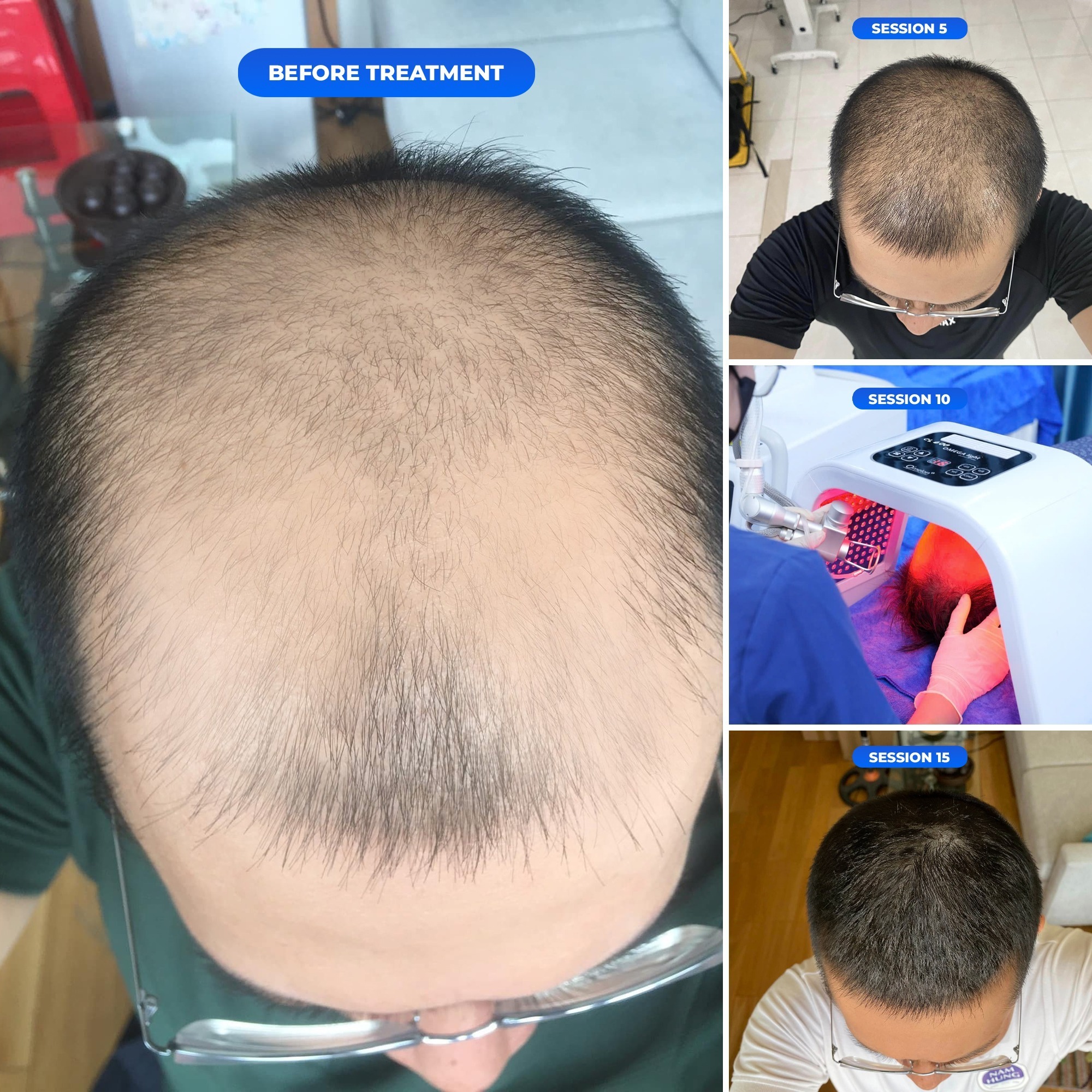 Lustro Beauty Center Facebook ad: Hair density visibly improves after 1 package at…