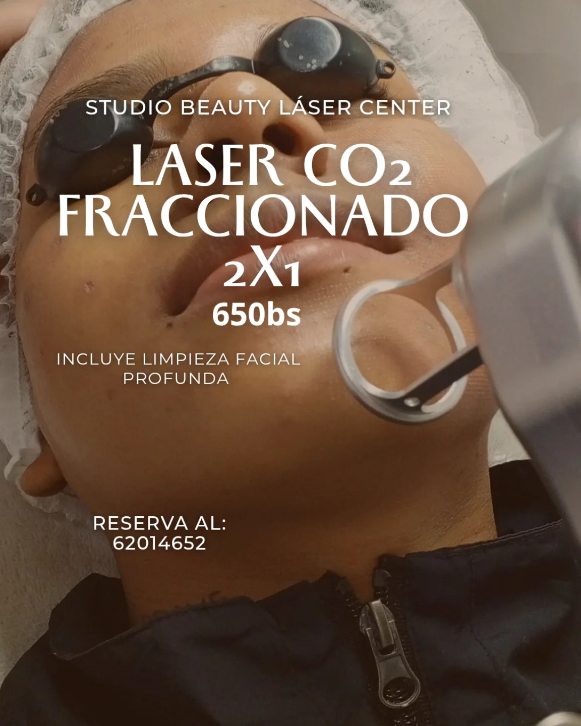 Studio Beauty laser center Facebook ad: SECUELAS DE ACNÉ