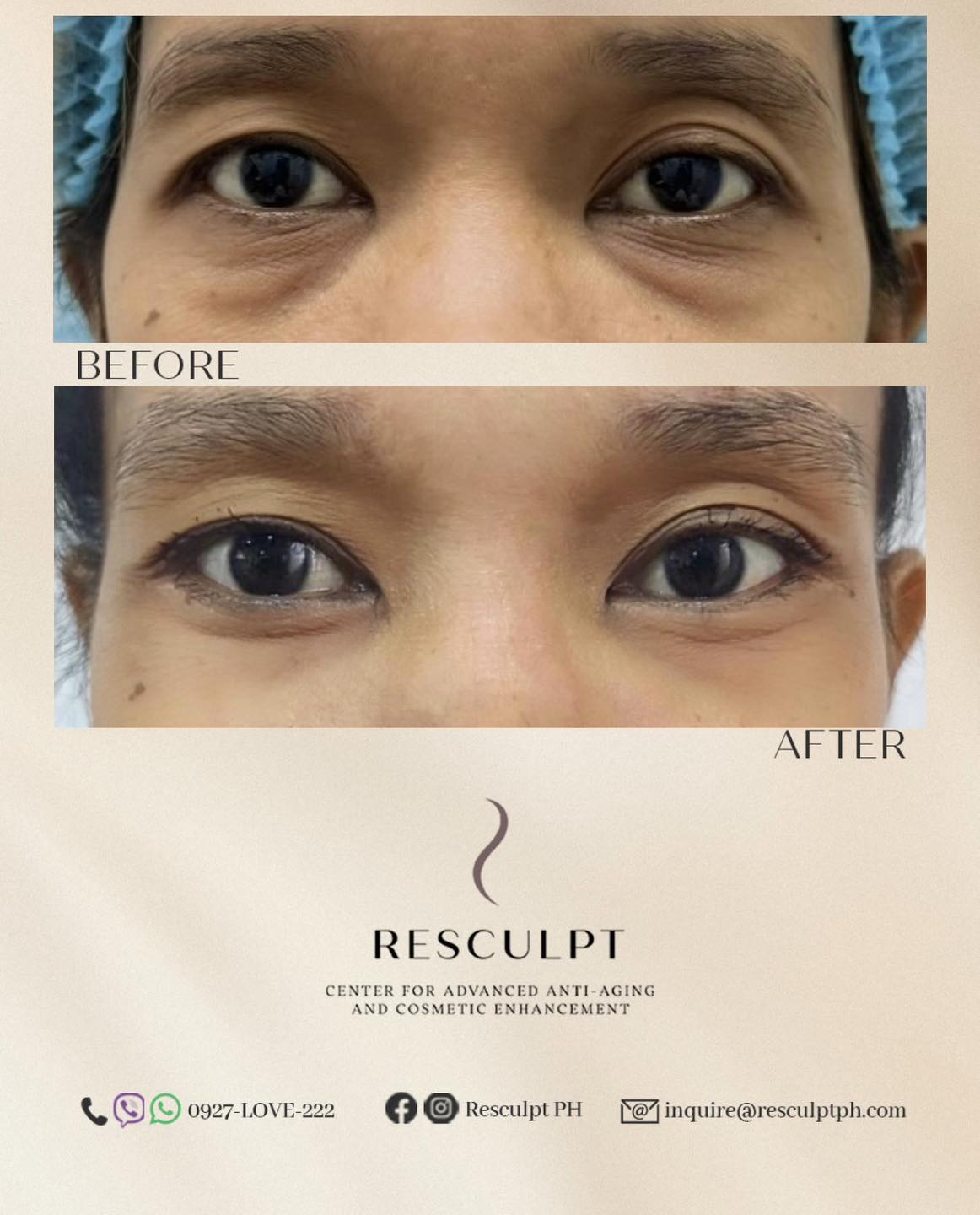 Resculpt PH Facebook ad: LOWER BLEPHAROPLASTY WITH FAT REPOSITIONING AND CANTHOPEXY