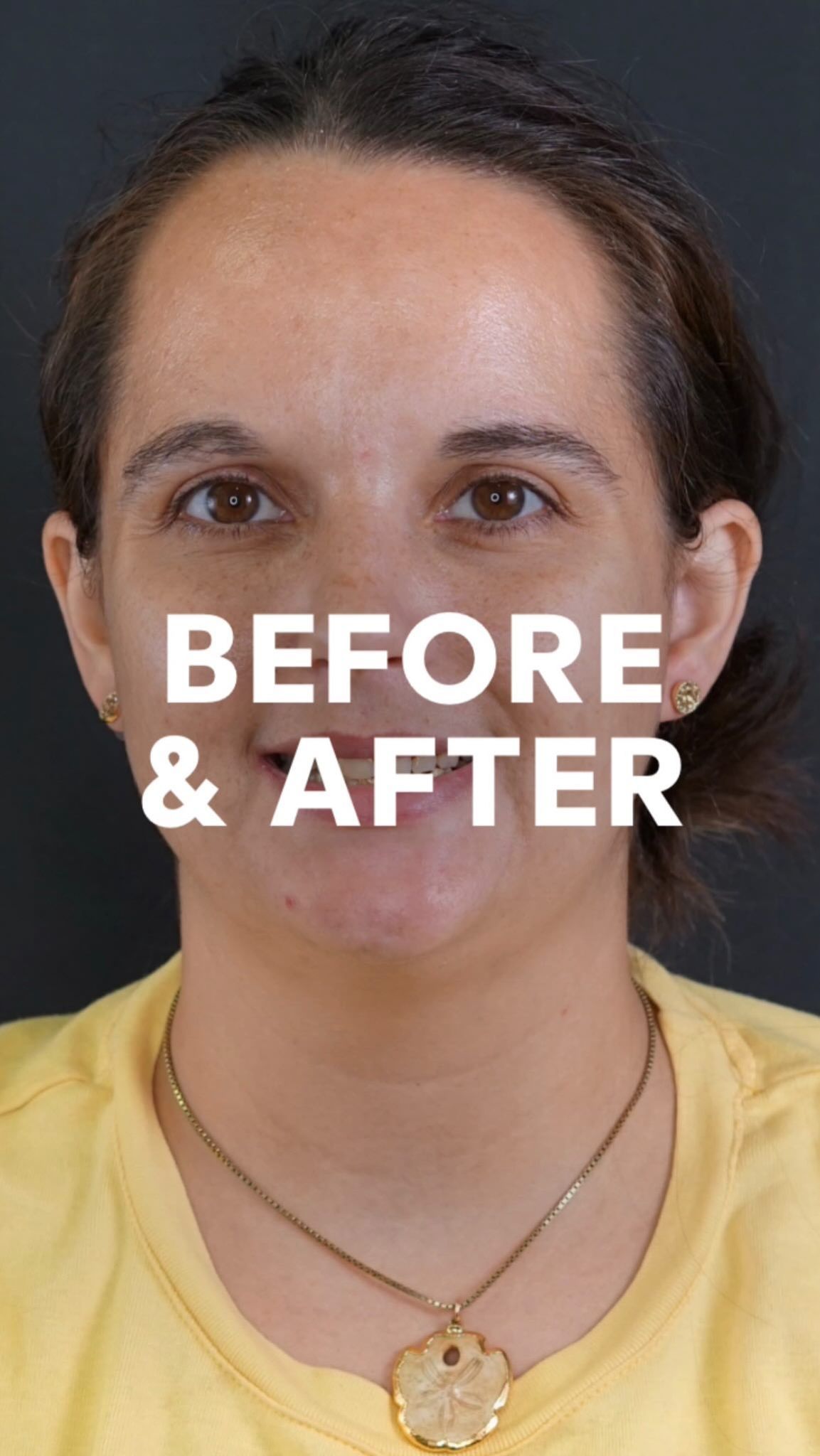 New Life Dental Implants Facebook ad from Apr 2, 2026