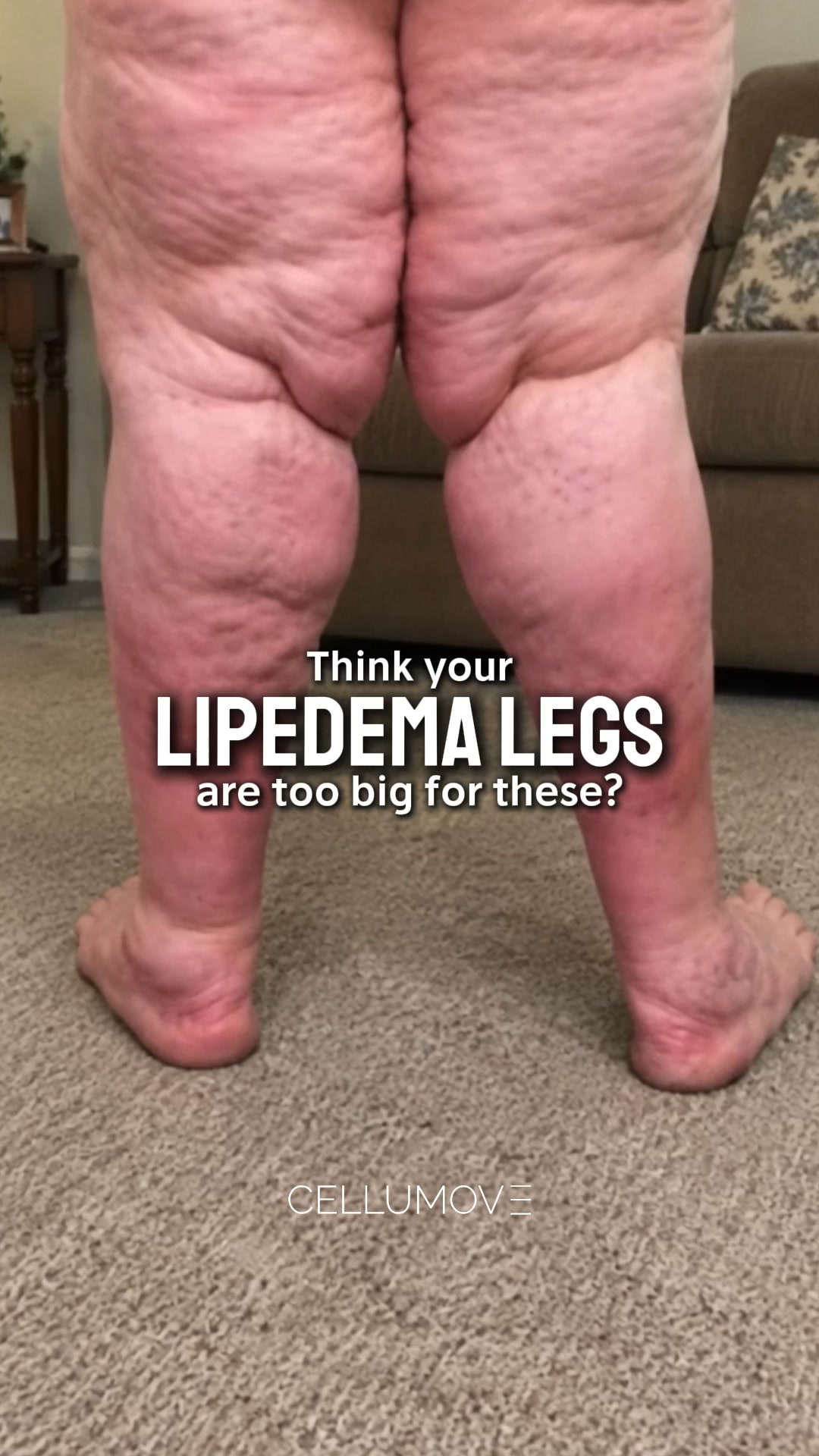 Cellumove Facebook ad: Start your lipedema relief today.
