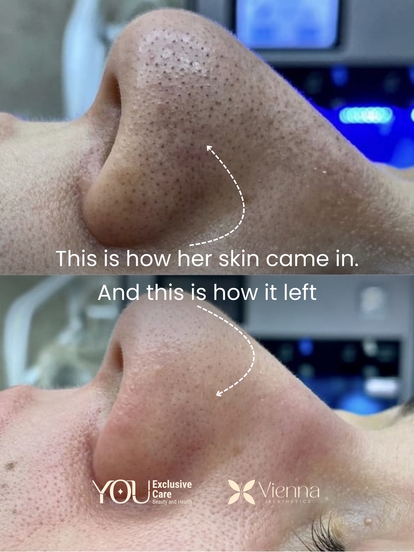 You Exclusive Care Tyngsborough Facebook ad: She walked in with clogged pores, rough texture…