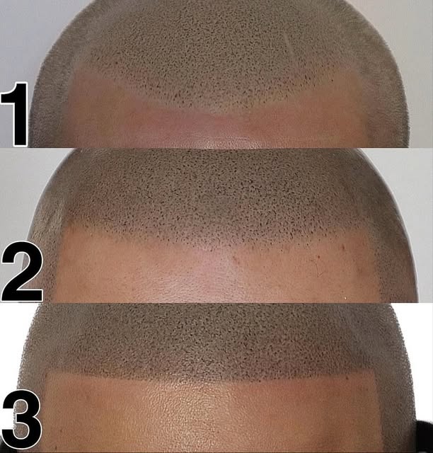 Micropigmentation Capillaire by. Idriss Soum Facebook ad