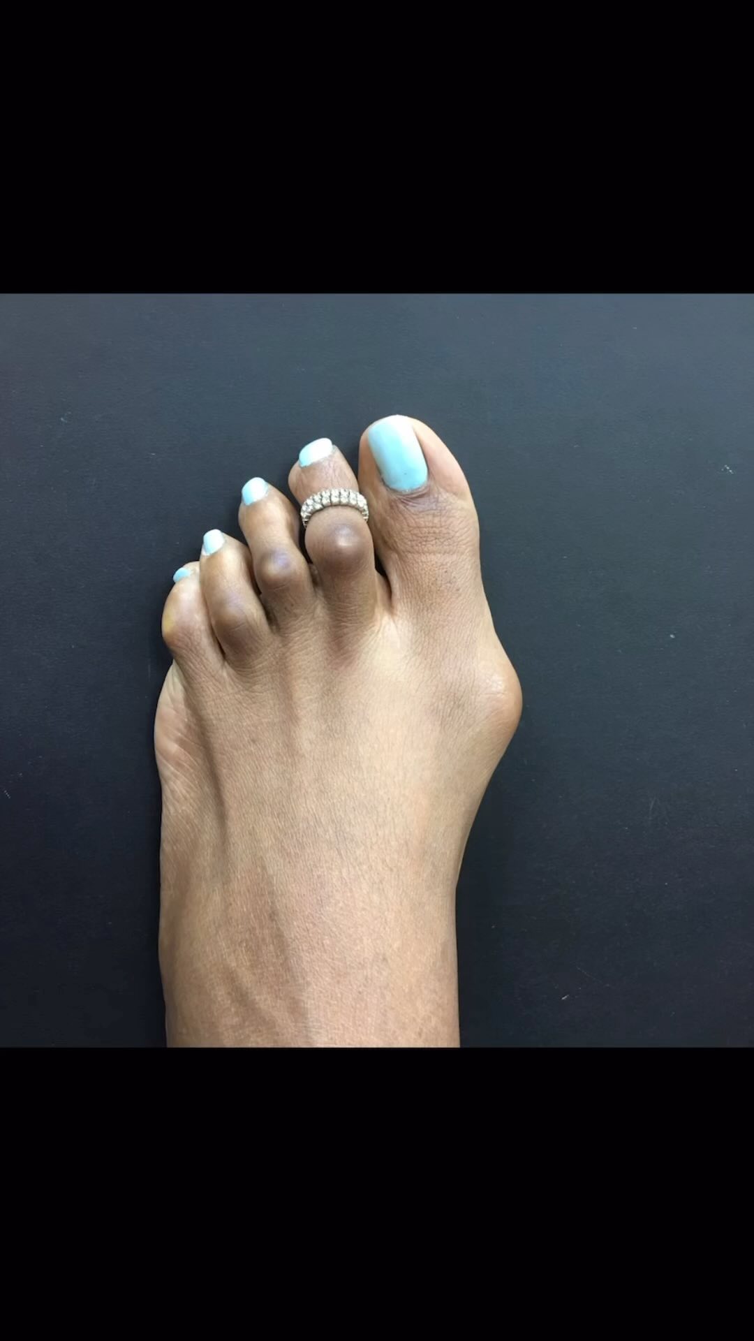 Foot First Podiatry Centers Facebook ad: How long a result will last after surgery…