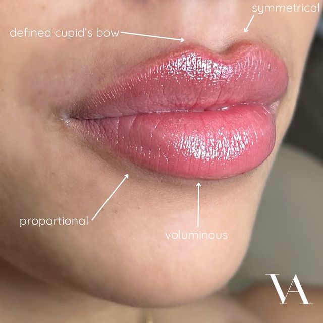 Venus Aesthetics Miami Facebook ad: MIAMI LIP FILLER