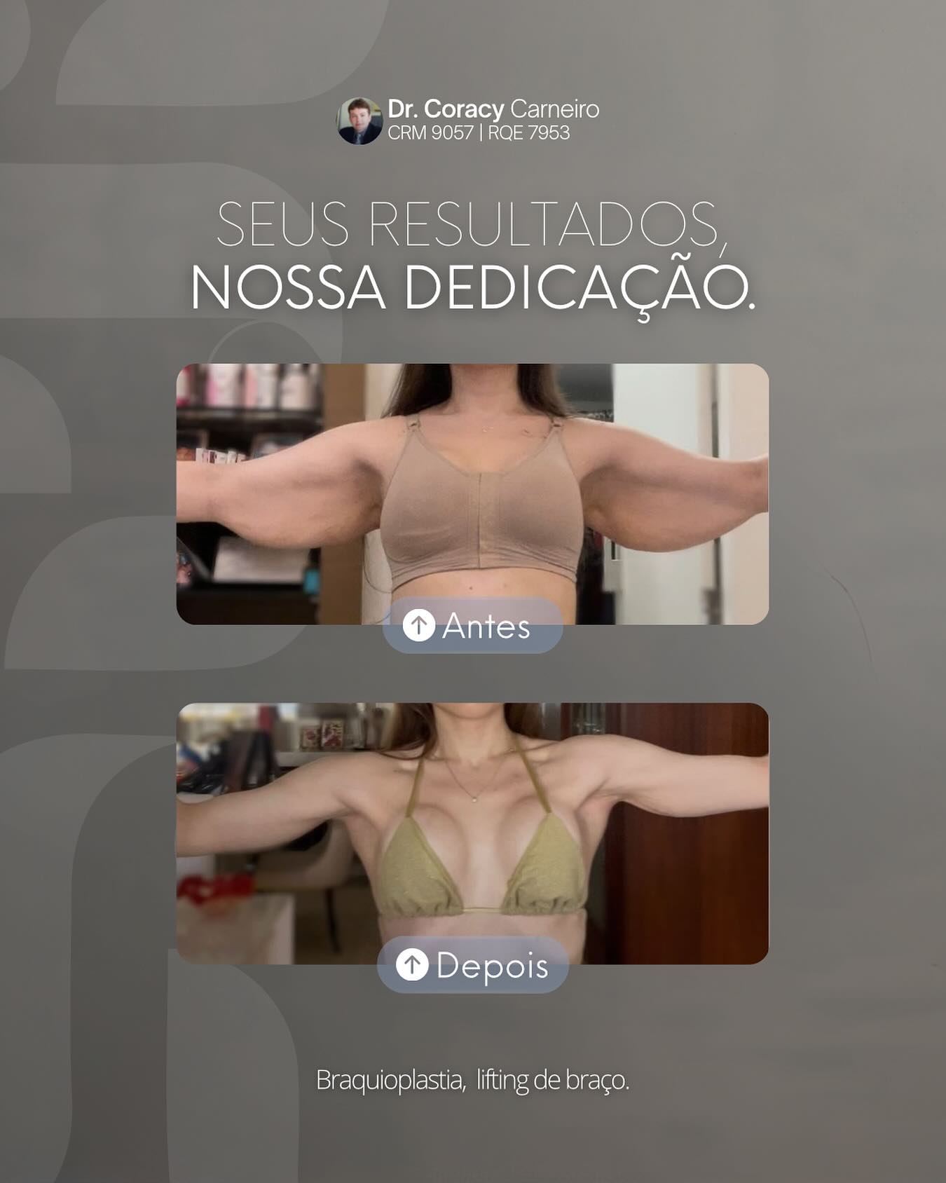 Dr Coracy Carneiro Facebook ad: O antes e depois do lifting de braço…