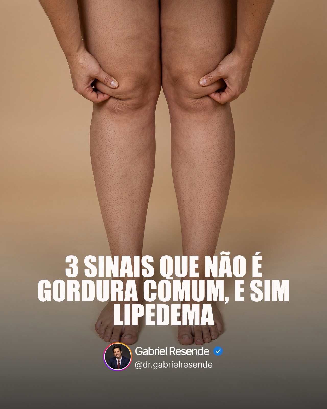 Dr. Gabriel Resende - Emagrecimento Facebook ad: O lipedema é uma condição crônica que afeta…
