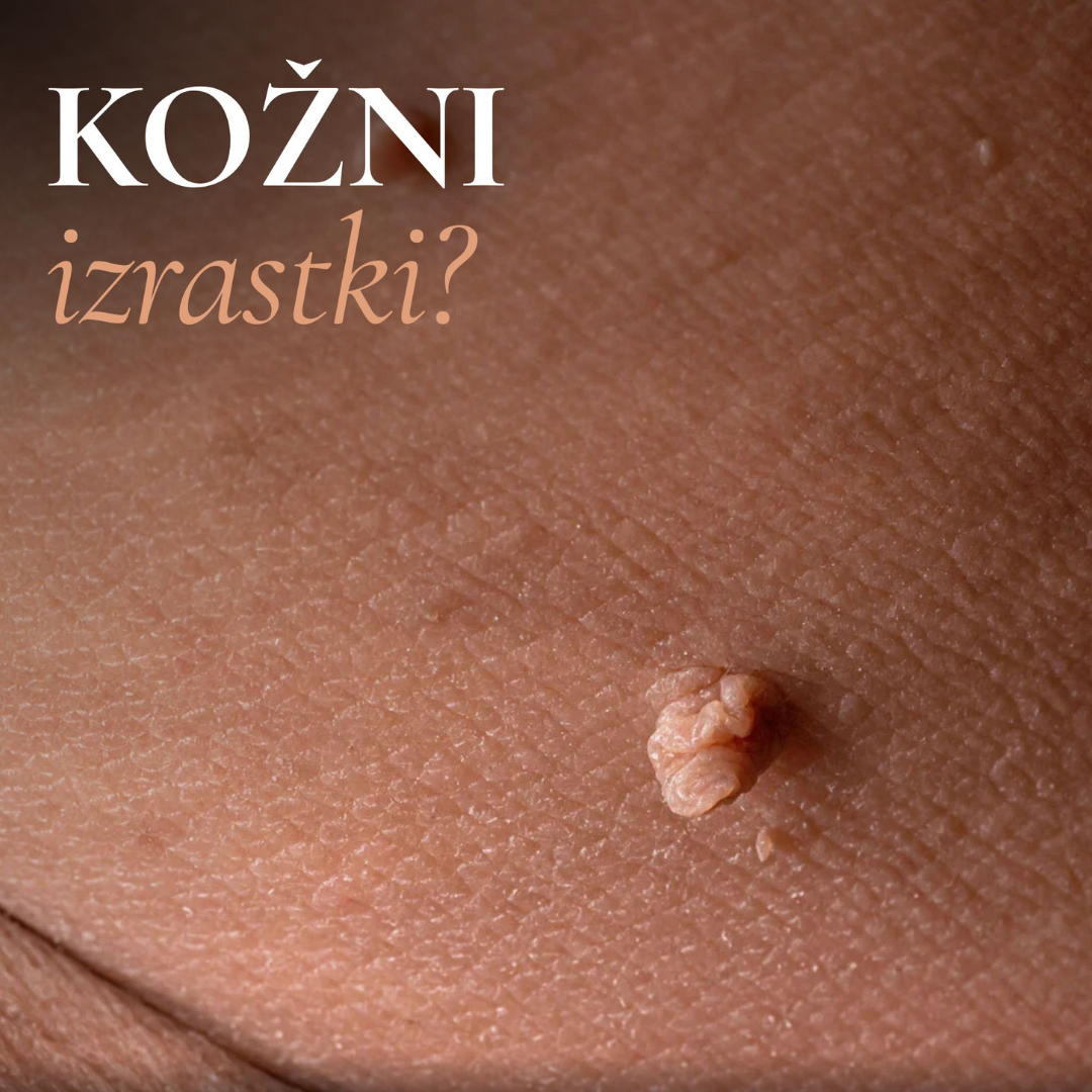 Estetski center Crystal Facebook ad: KOŽNI IZRASTKI?