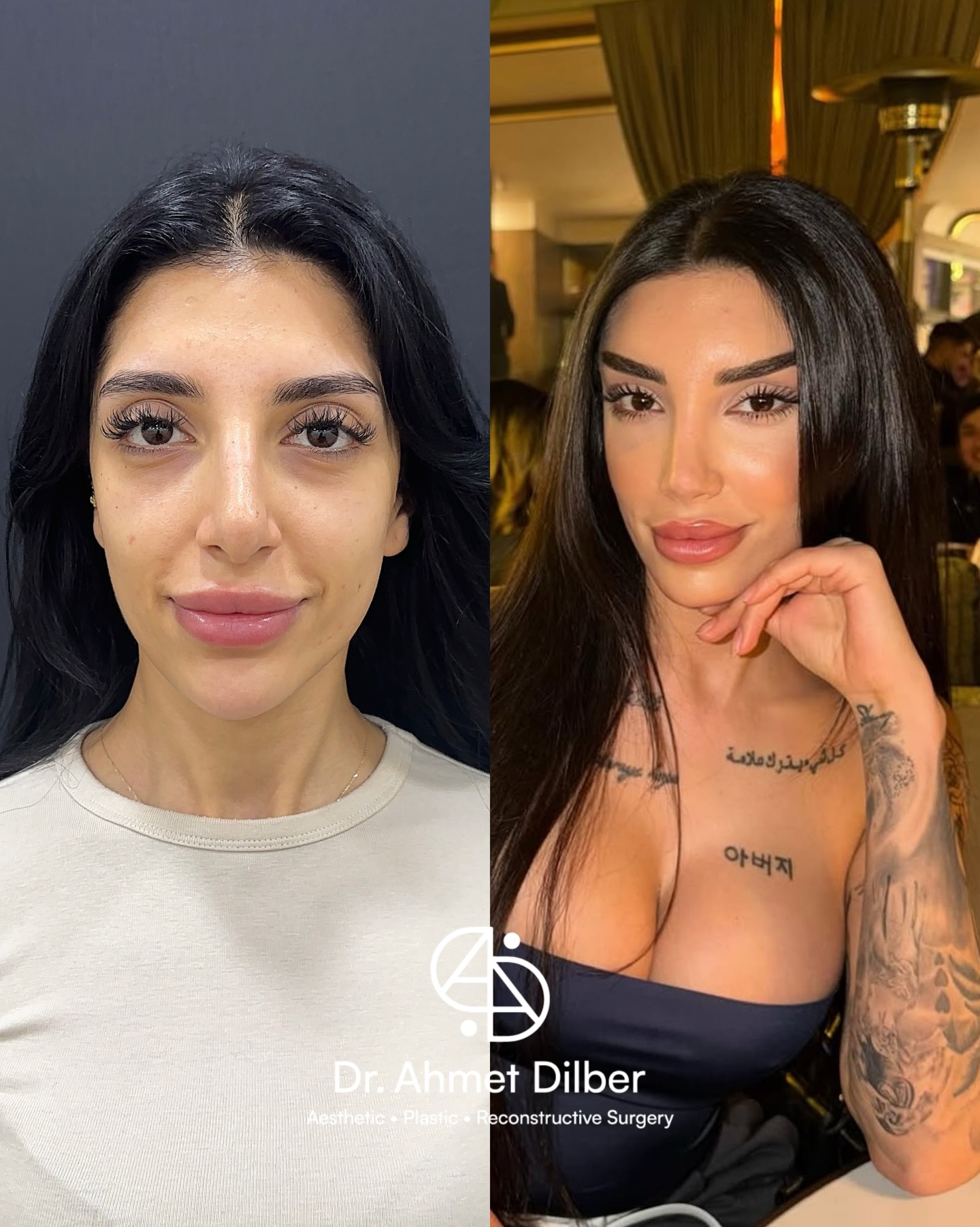 Op.Dr. Ahmet Dilber Facebook ad: FOX EYES + TEMPORAL LIFT + MID FACELIFT…