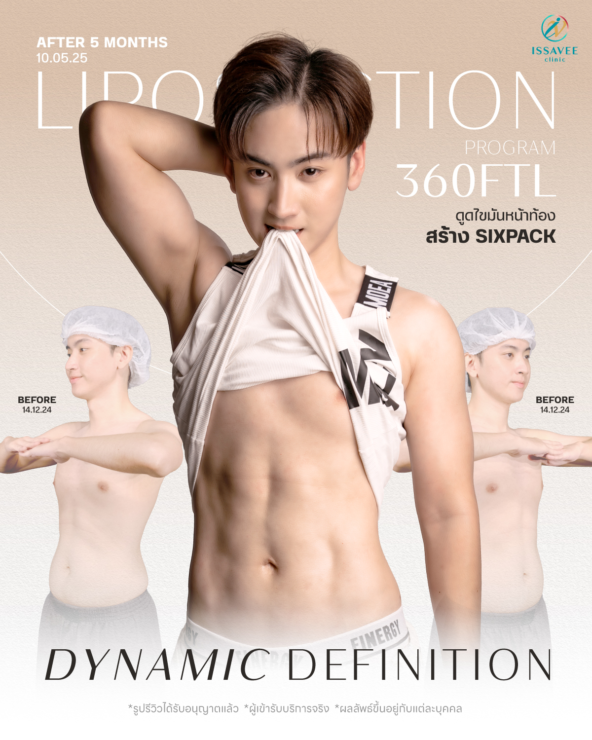 ดูดไขมัน 360 FTL by Issavee Clinic Facebook ad