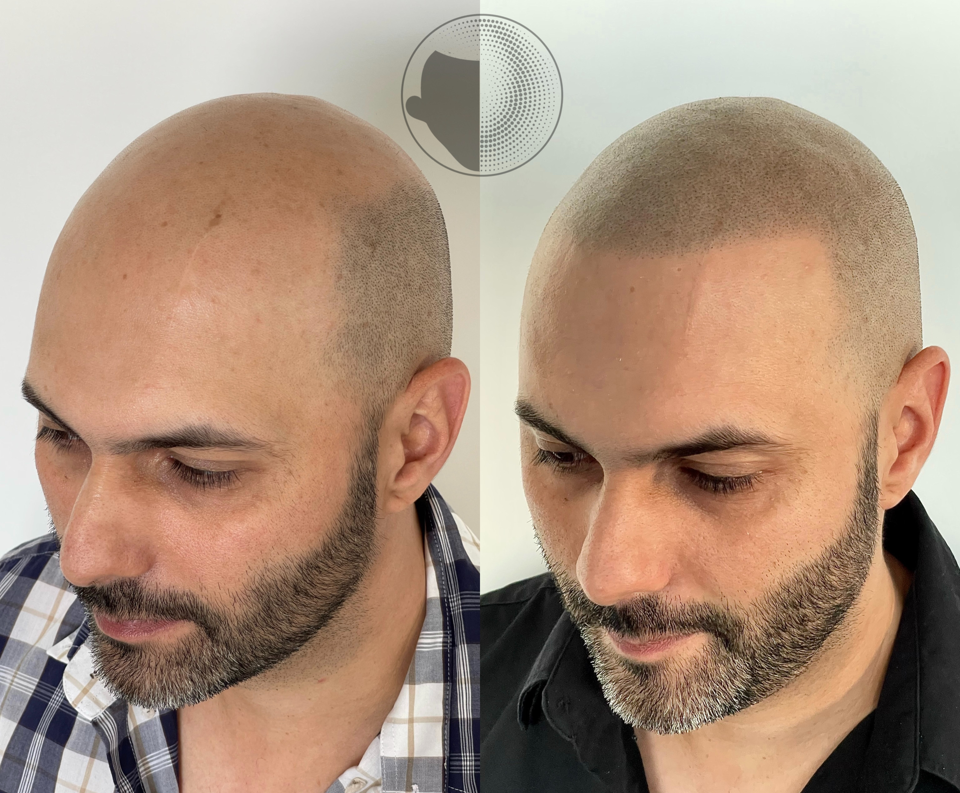 Sydney Scalp Master Facebook ad: Best Scalp Micropigmentation Services Five Dock & Sydney