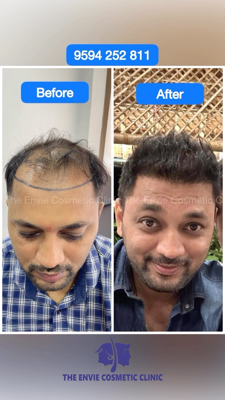 The ENVIE Cosmetic Clinic Facebook ad: Bald to Bold!