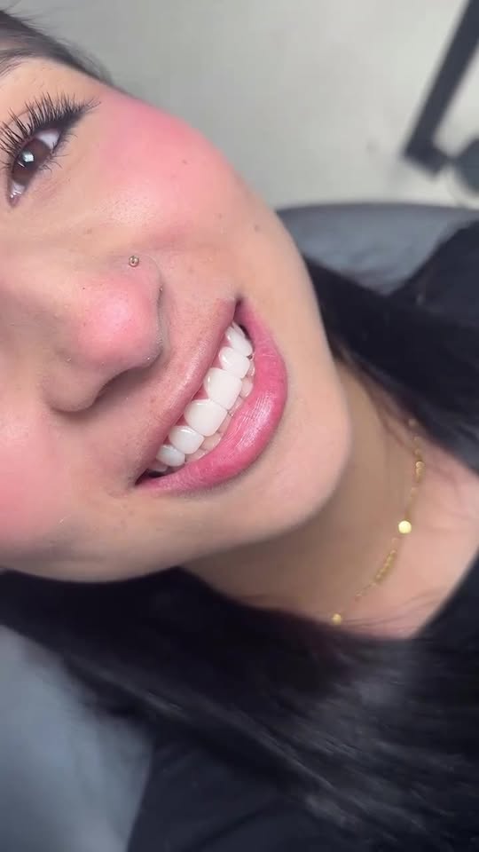 Id Dental Facebook ad: Carillas de resina sin desgaste