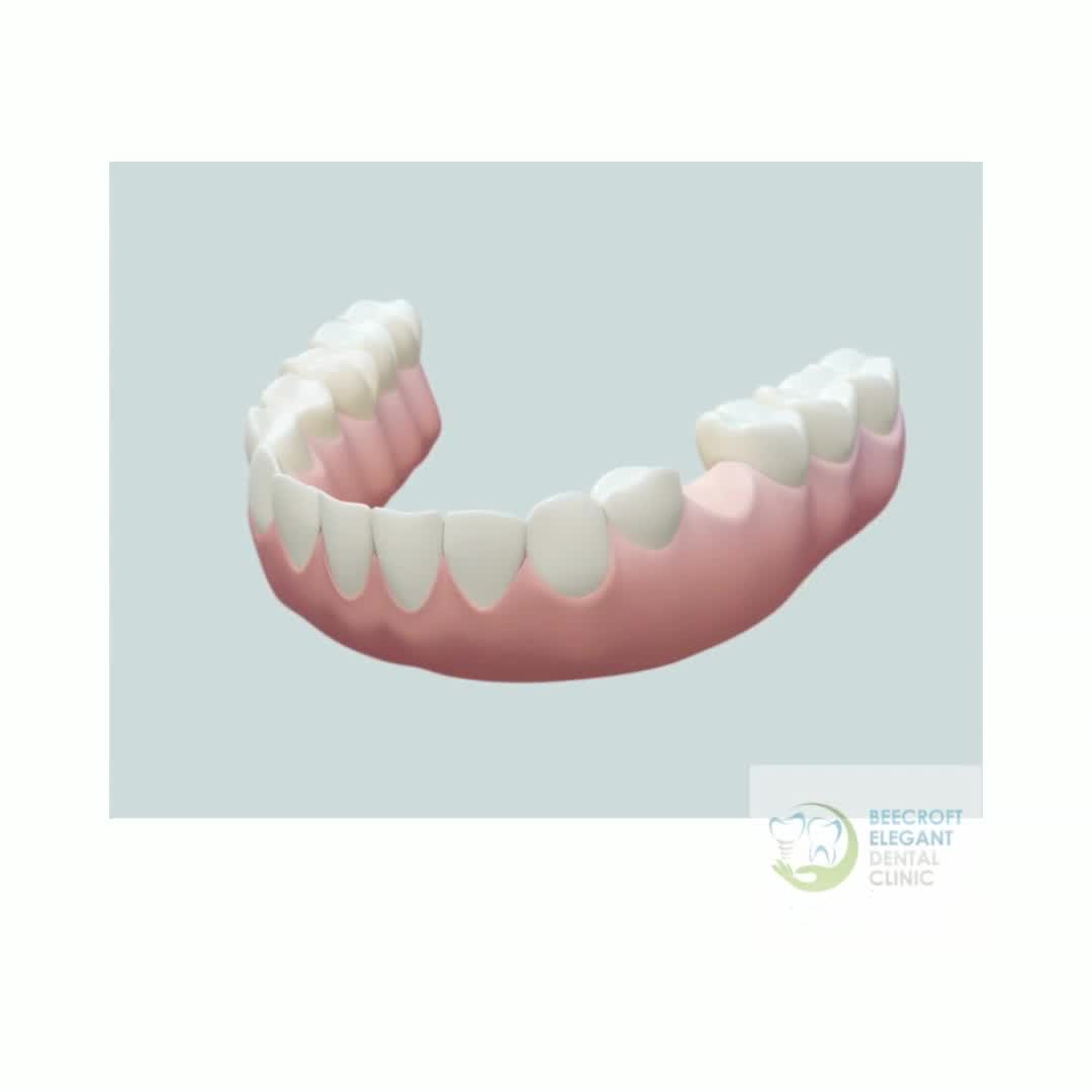 Beecroft Elegant Clinic - Dental Implants Facebook ad: Full-arc (All on 4) dental Implants