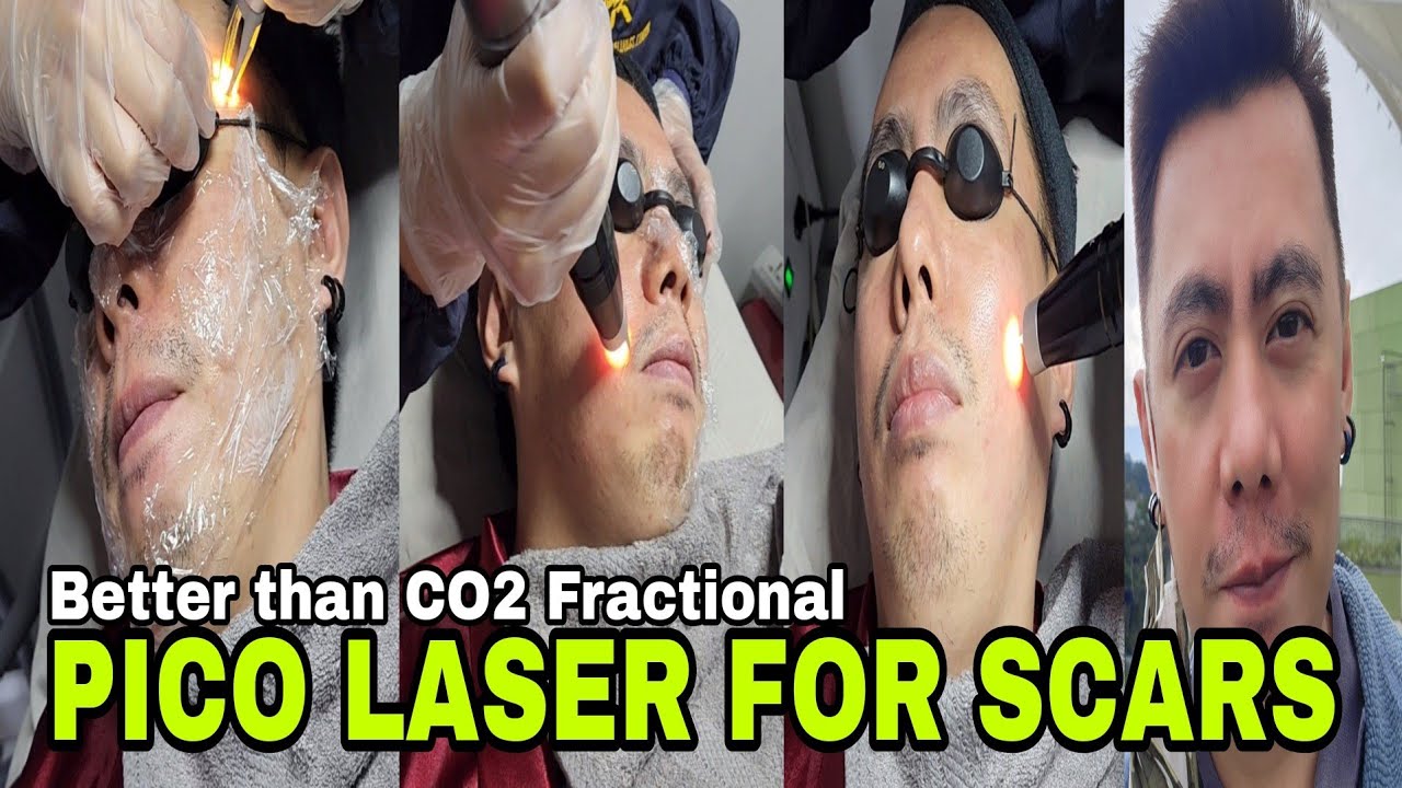Rhodagenix aesthetic and wellness center Facebook ad: BETTER THAN CO2 FRACTIONAL | 1ST Pico Laser Treatment for…