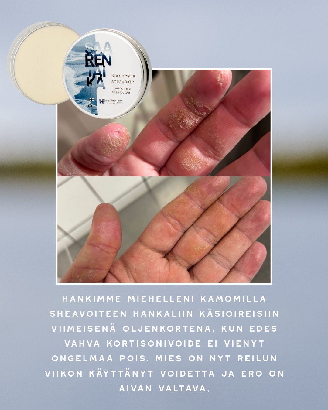 Saaren Taika Facebook ad: Halkeilevat sormenpäät - Mitä tehdä kun kädet kuivuu…