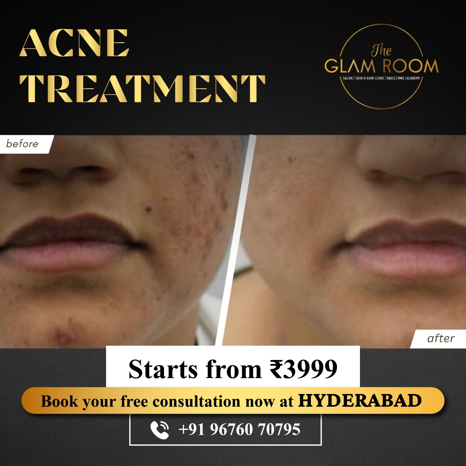 The glam room clinic Facebook ad: Hyderabad's Most Trusted Skin Clinic is here!