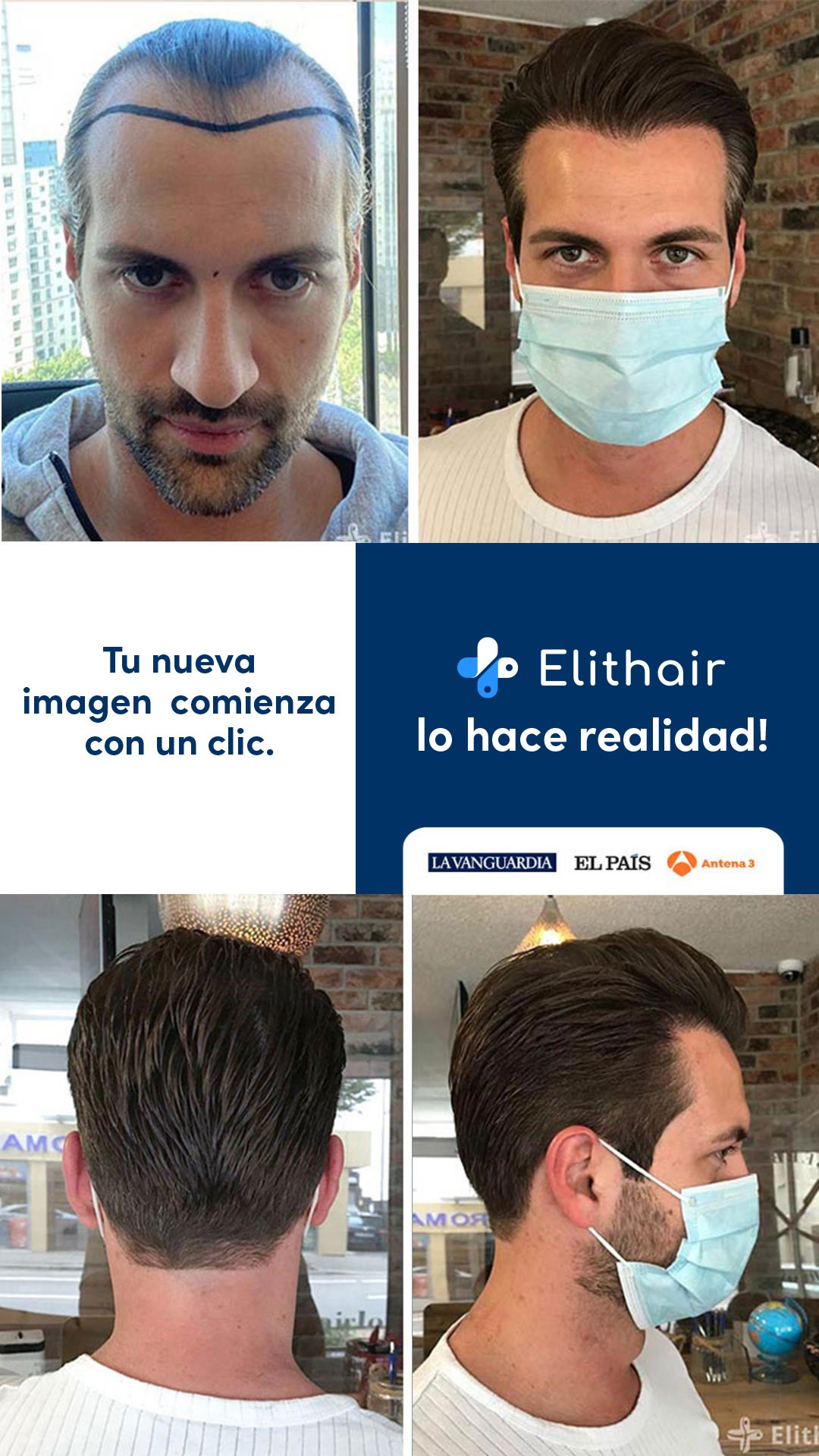 Trasplante Capilar Turquía - Elithair Facebook ad