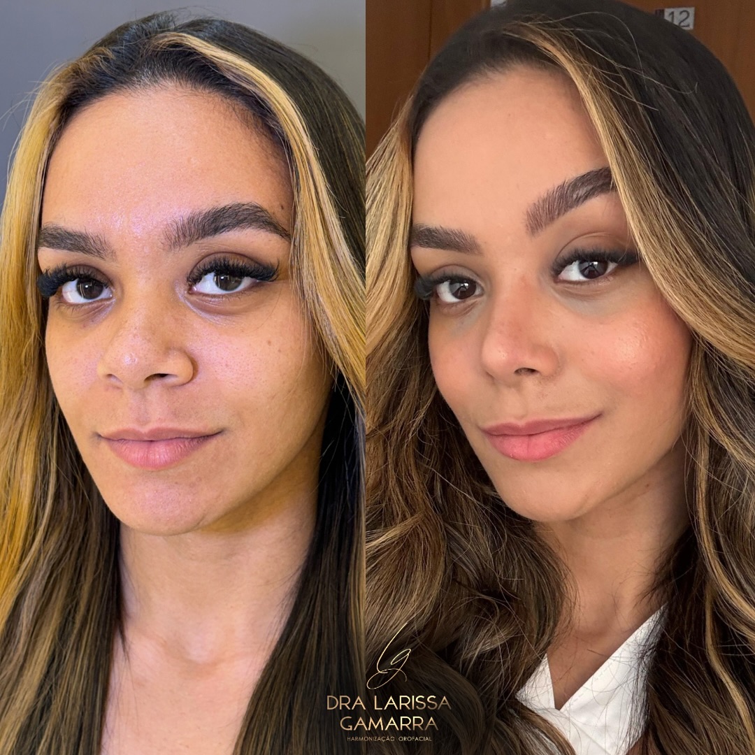 Dra Larissa Gamarra Facebook ad: Antes e depois de uma Rinomodelação com fios…