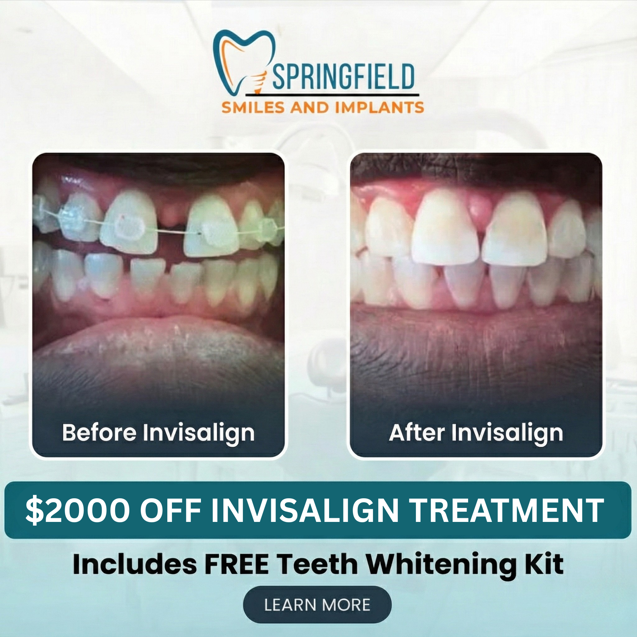 Springfield Smiles & Implants Facebook ad: Get $2,000 OFF Invisalign New Year Special, Limited Time…