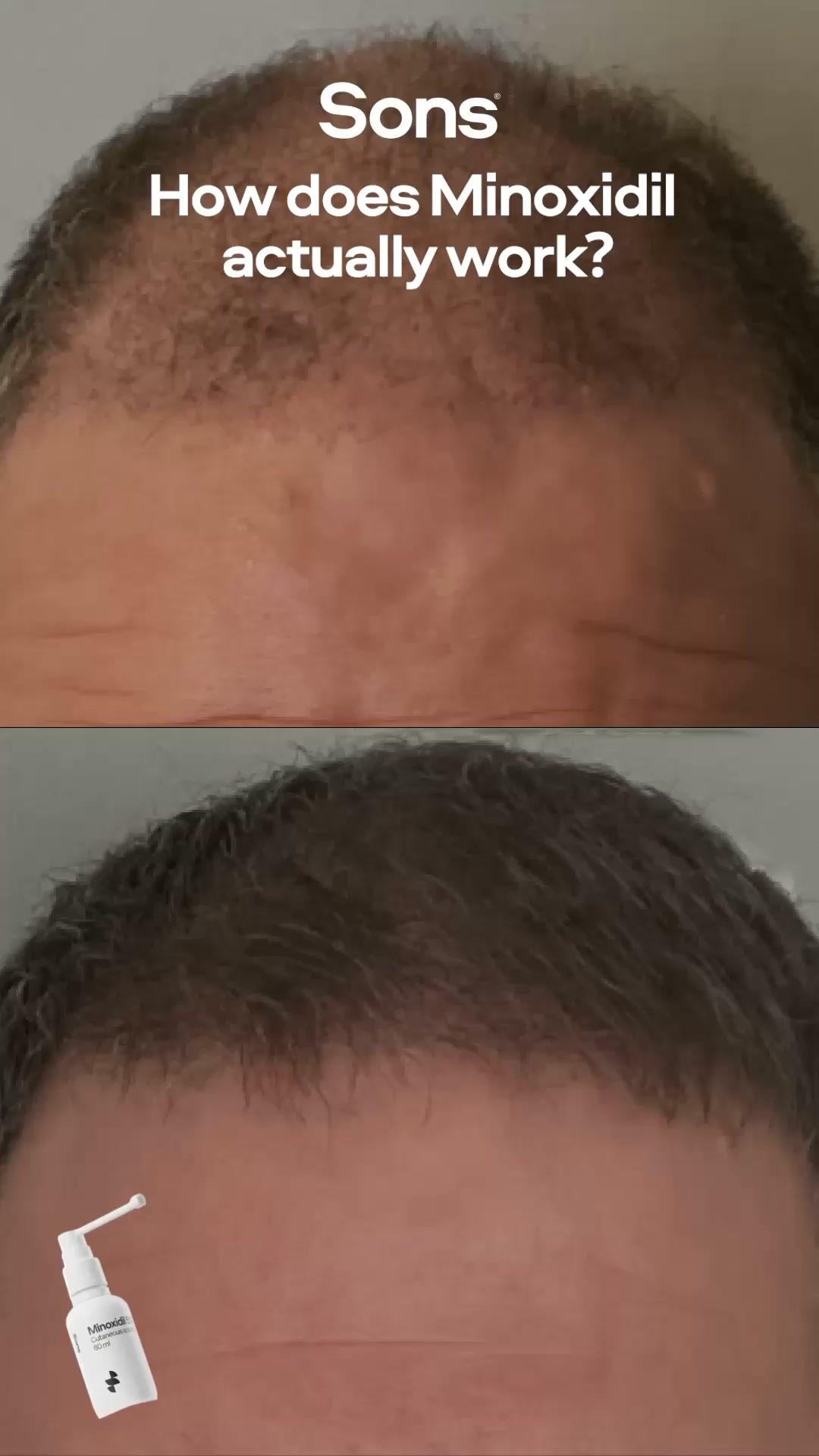 Sons Facebook ad: Your hairline. Your call.