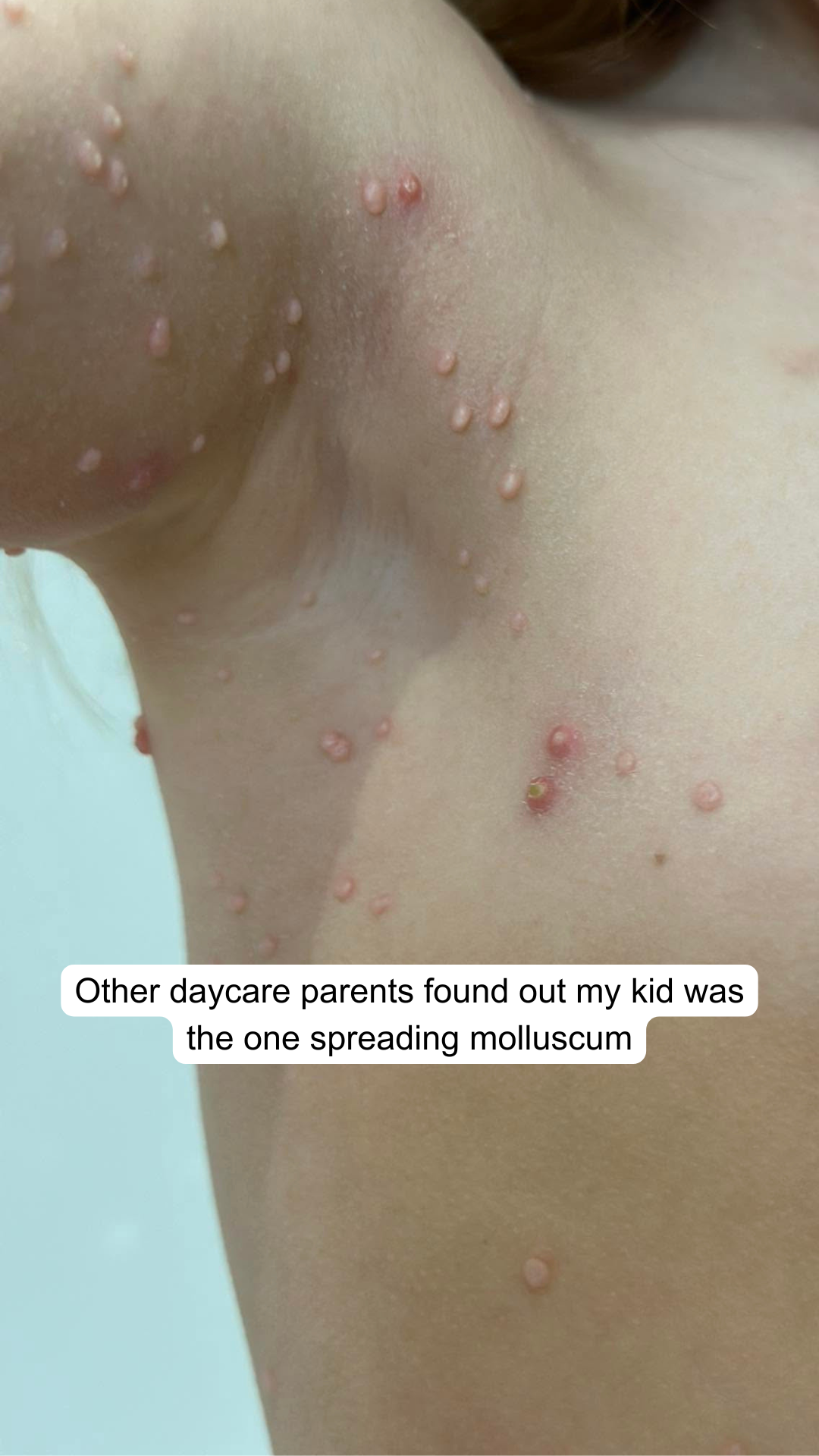 Orvele Facebook ad: Heal Molluscum Before Contamination